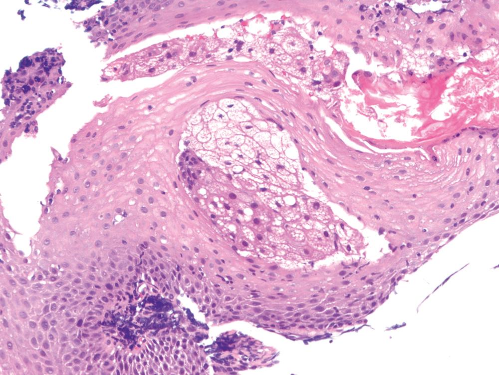FIGURE 19.4, Examination of this esophageal polyp at high power reveals sebaceous glands embedded within the squamous epithelium.