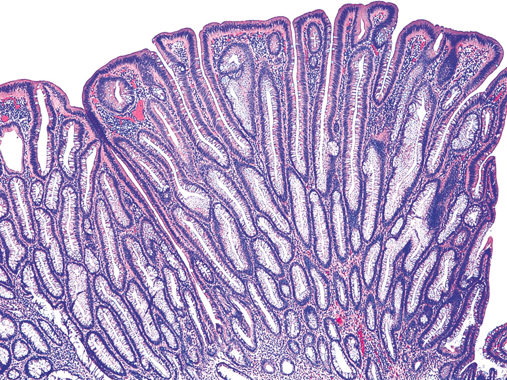 FIGURE 22.2, Tubular adenoma with predominantly tubular architecture.