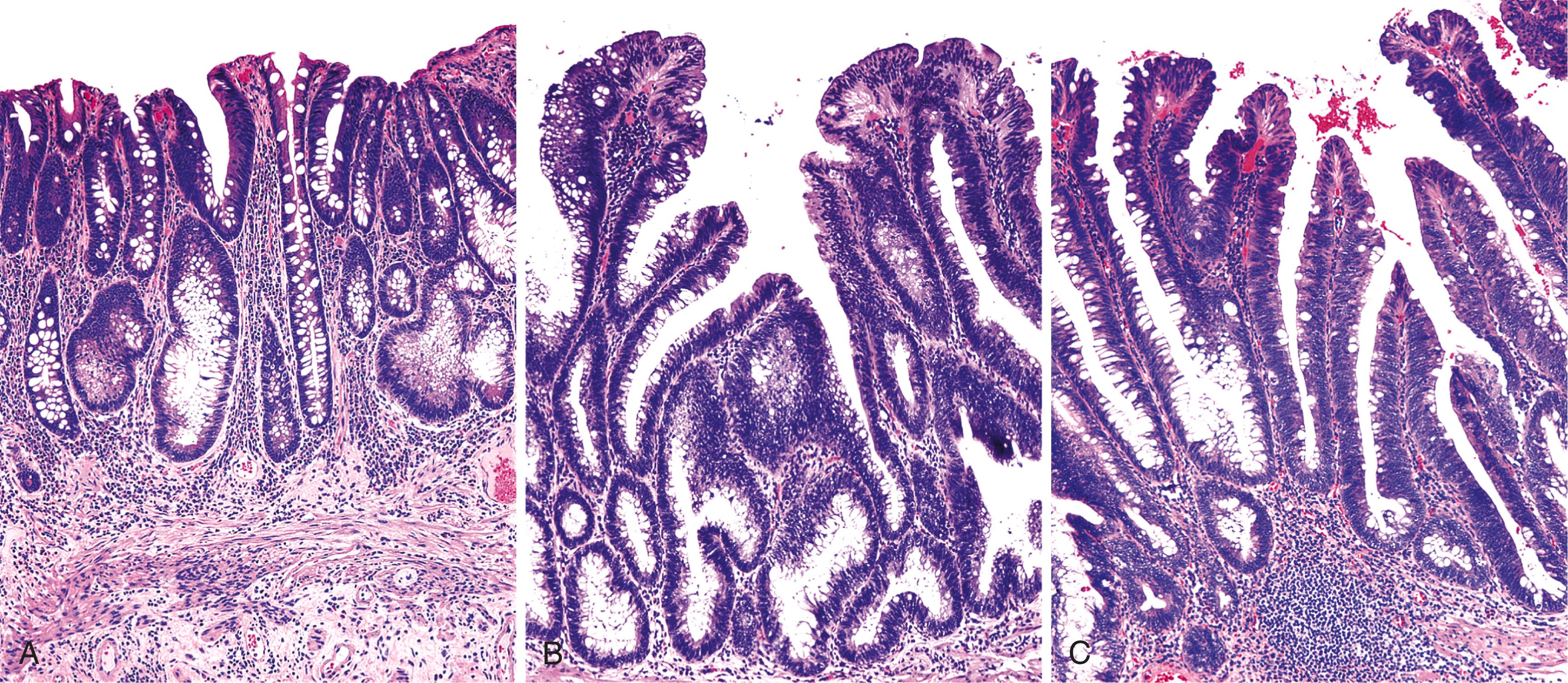 FIGURE 22.3, Each of these three adenomas displays low-grade dysplasia, but the architecture varies from tubular (A) to tubulovillous (B) to villous (C) . The loss of architectural rigidity is a common finding in adenomas.