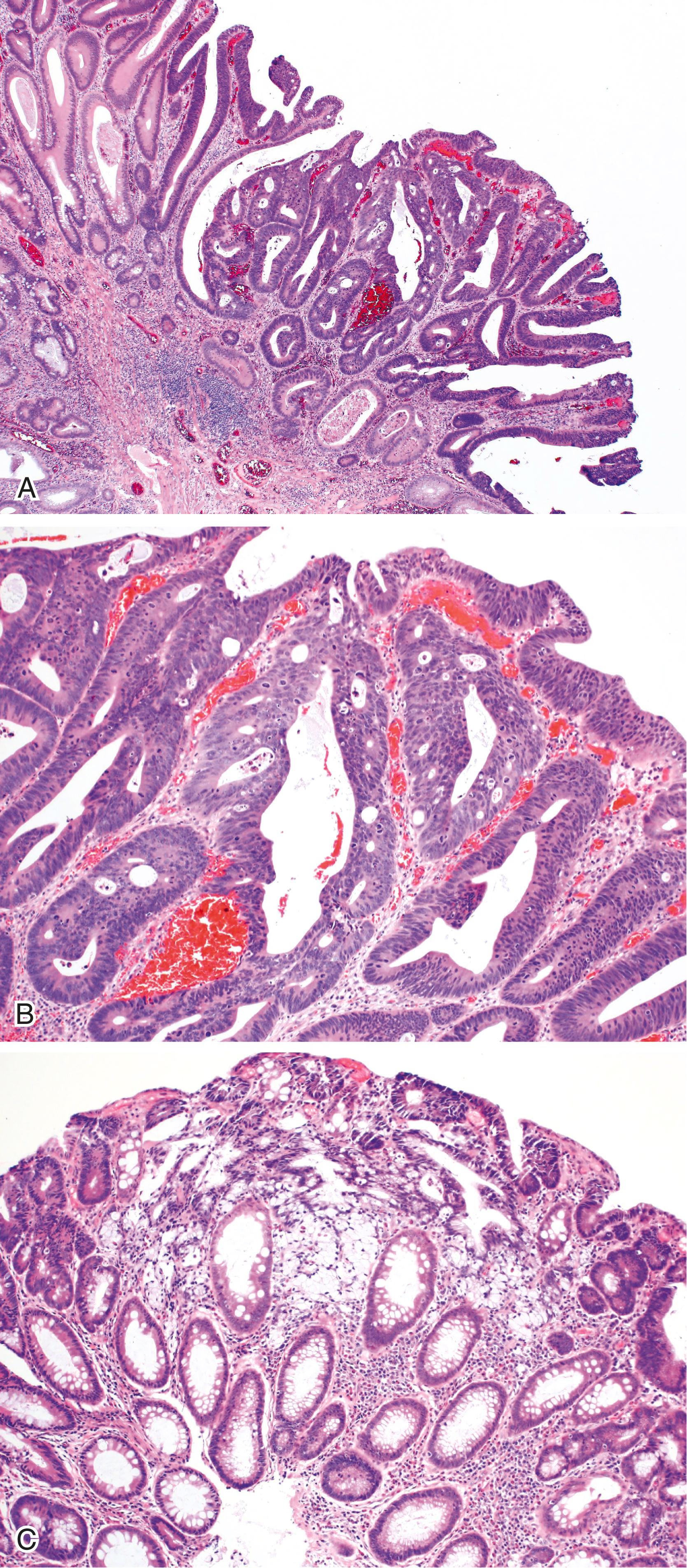 FIGURE 22.5, High-grade dysplasia and intramucosal adenocarcinoma in an adenoma.