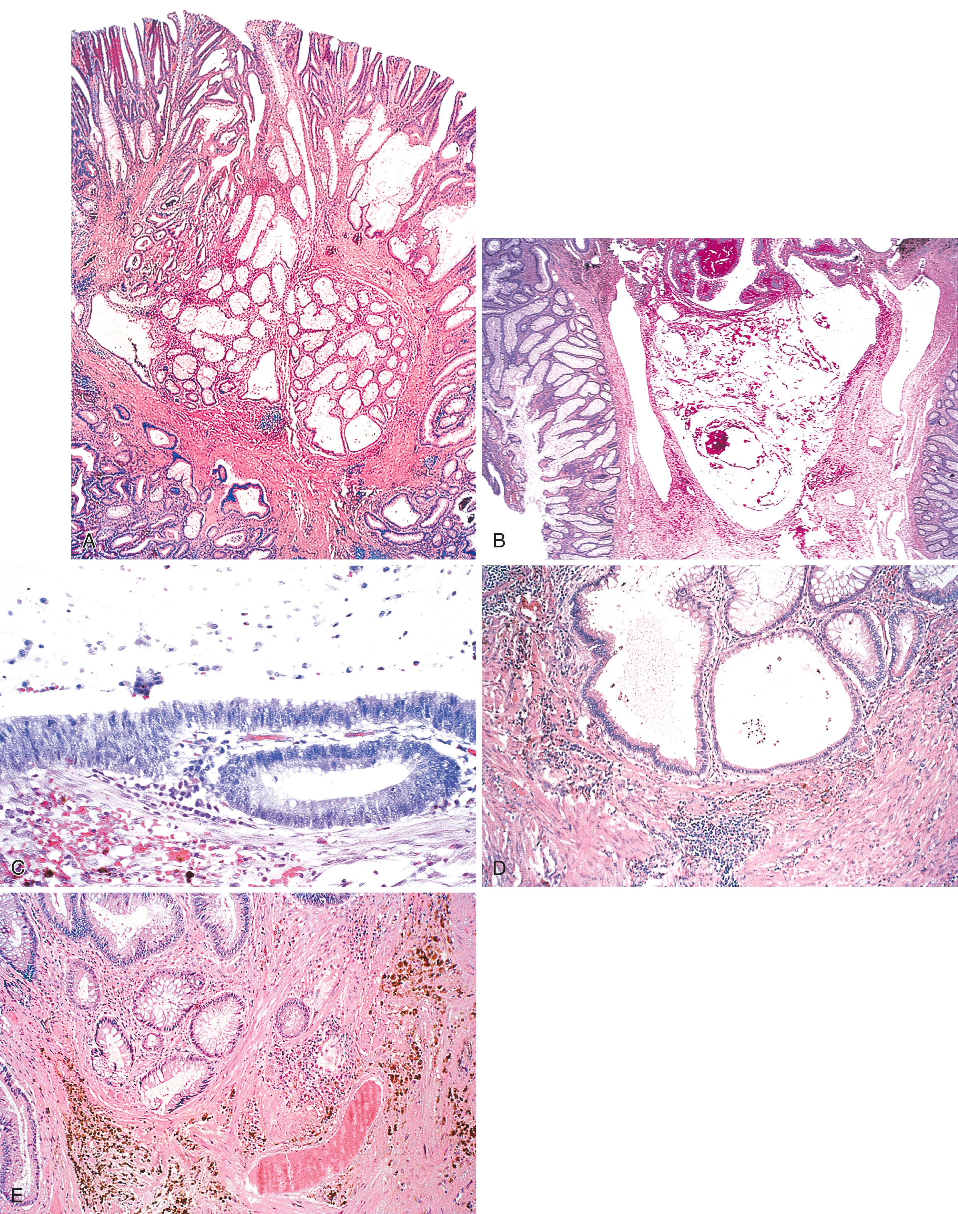 FIGURE 22.6, Adenoma with epithelial displacement (pseudoinvasion).