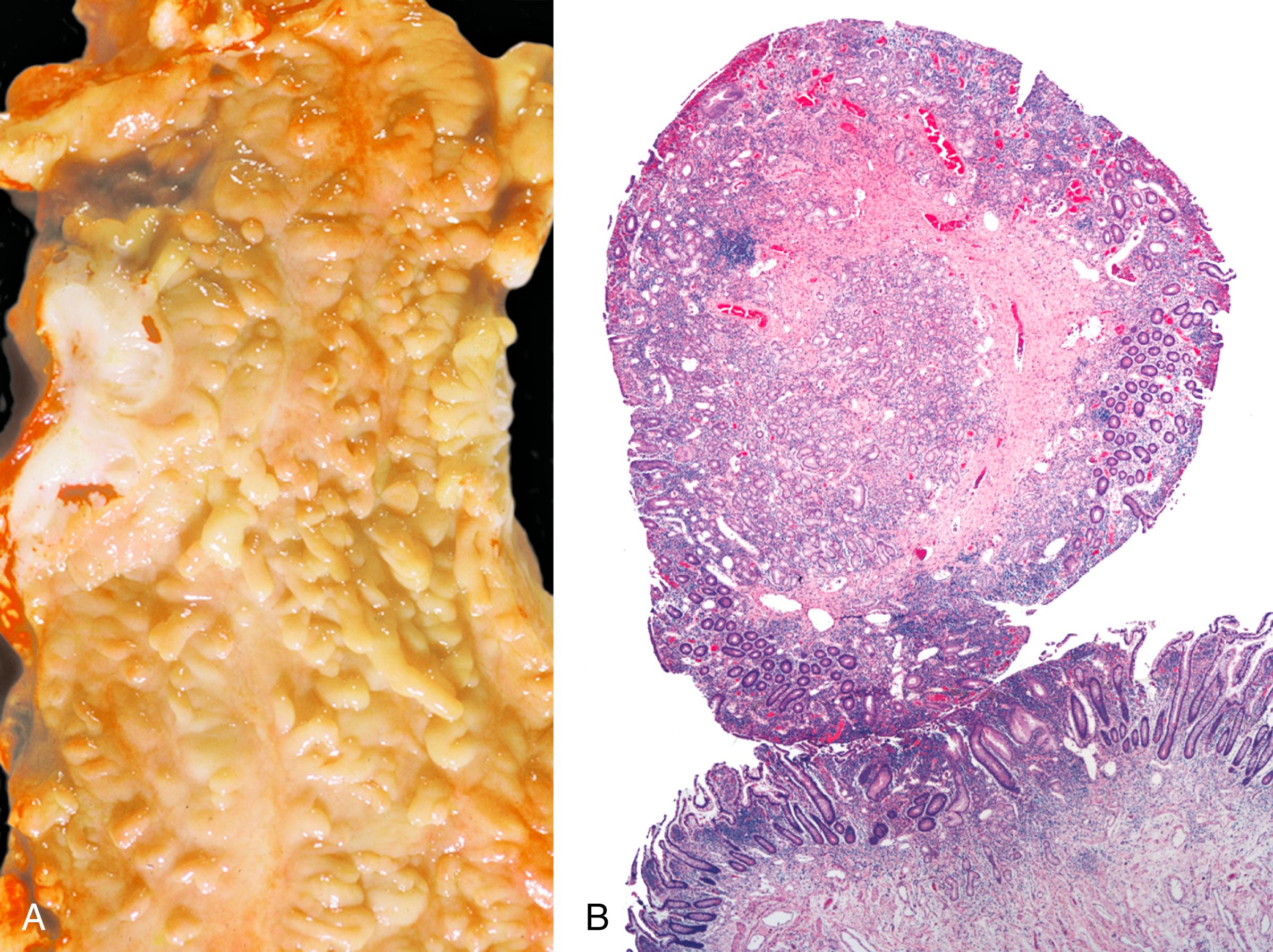 FIGURE 21.1, Crohn’s disease–associated “pseudopolyps” of the ileum. A, Much of the ileal mucosa is flattened and atrophic, and residual plaquelike and polypoid areas of mucosa are present. B, A polypoid excrescence of mucosa is preserved in an area of the ileum affected by active ileitis.