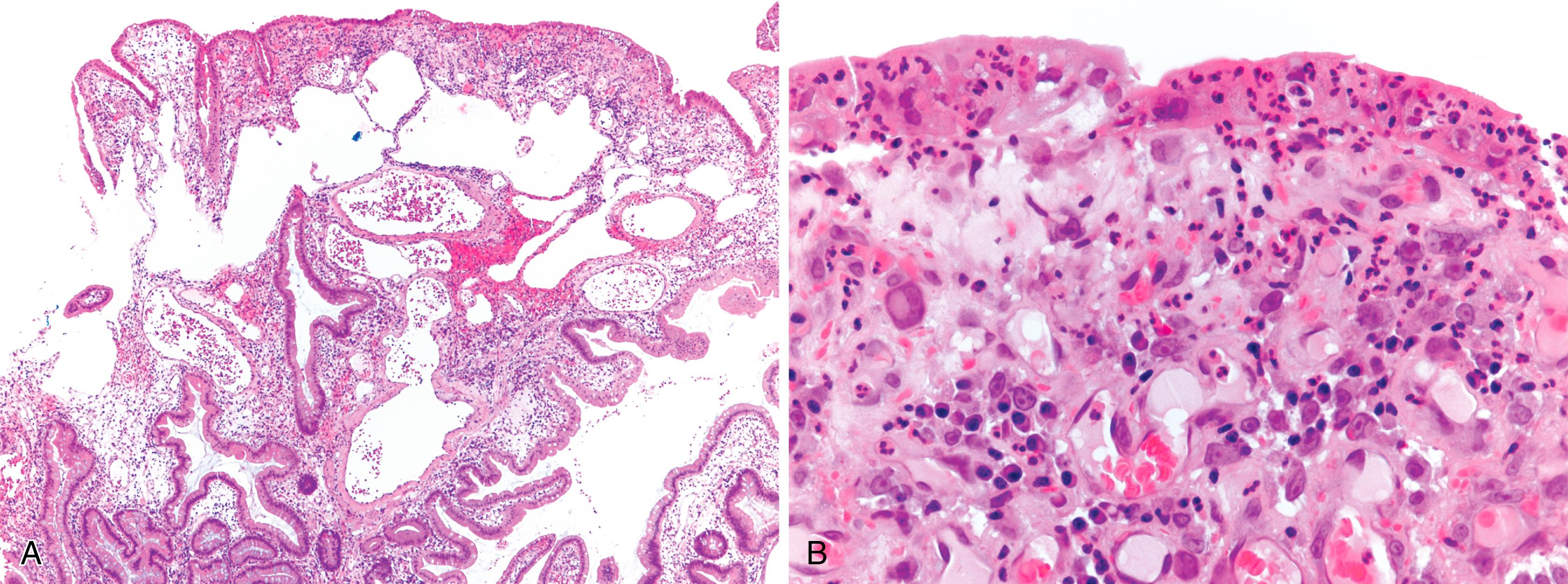 FIGURE 21.2, Cytomegalovirus-associated inflammatory polyp. A, This isolated inflammatory polyp has an expanded and edematous lamina propria with vascular ectasia. B, Numerous cytomegaloviral inclusions are identified.
