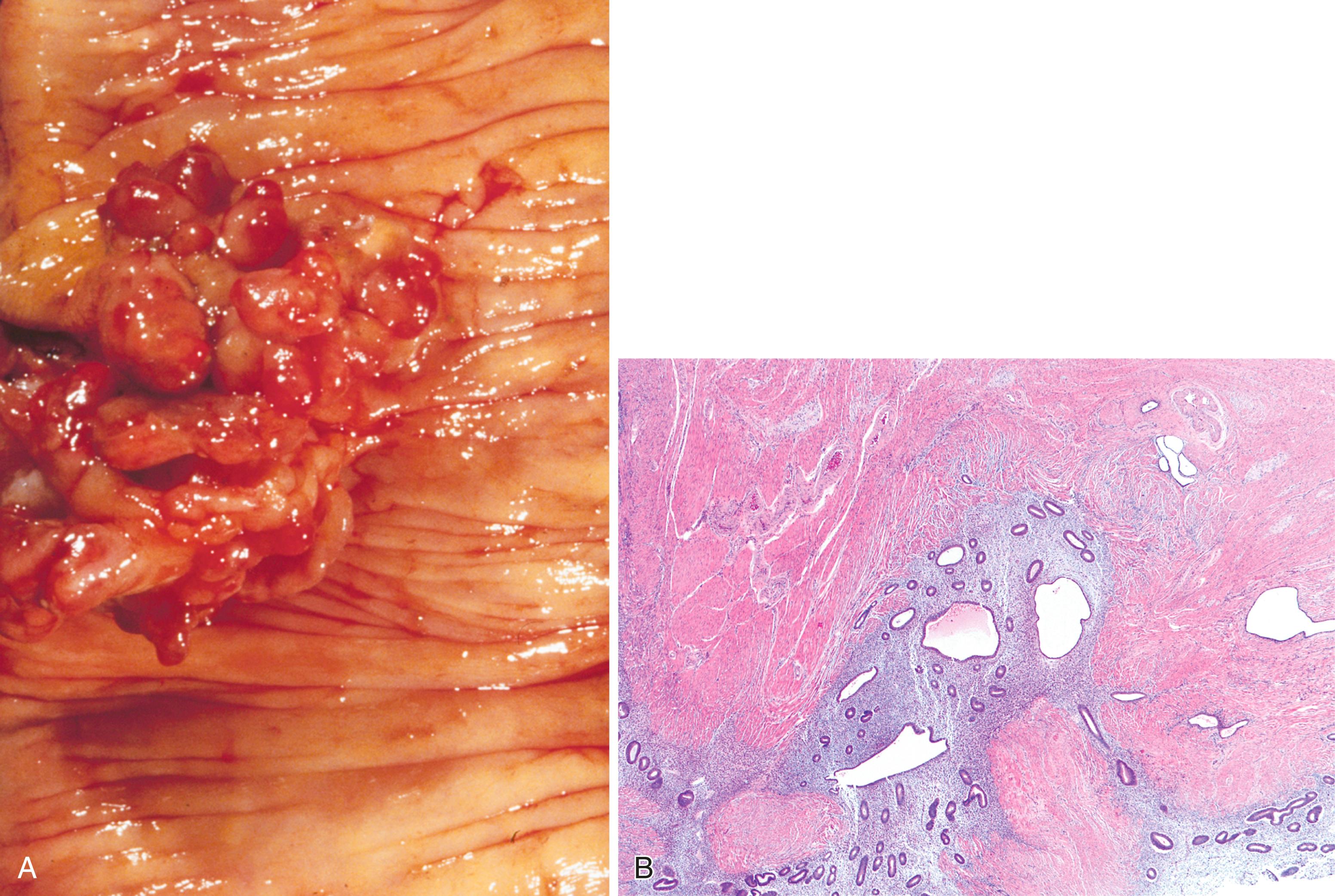 FIGURE 21.3, Endometriosis of the small intestine. A, Multiple erythematous polypoid lesions in an area of endometriosis. B, Rounded aggregates of endometrial glands and stroma infiltrate the muscularis propria.