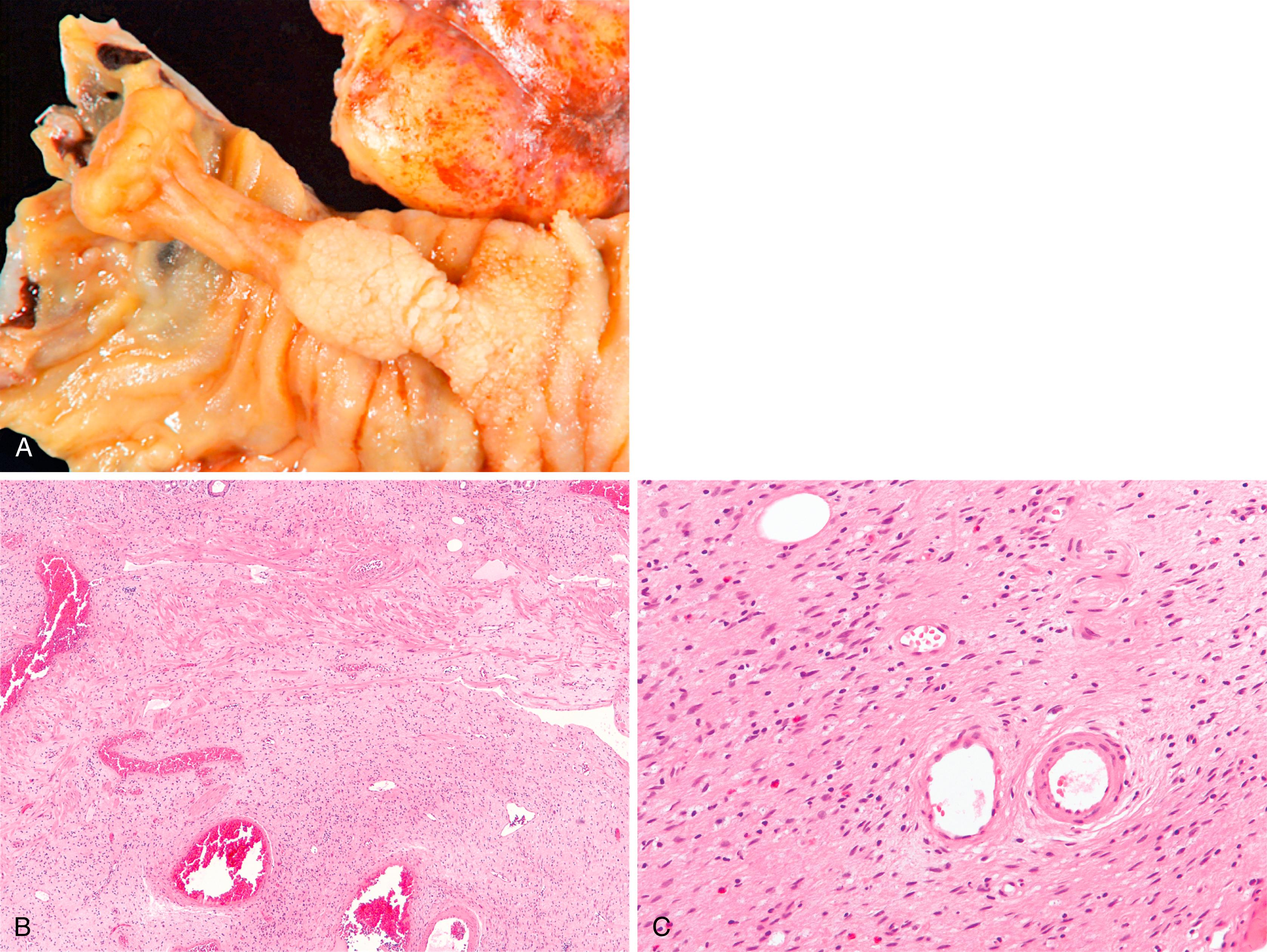 FIGURE 21.4, Inflammatory fibroid polyp of the duodenum. A, A well-circumscribed polyp is present in the submucosa. B and C, The tumor is composed of cytologically bland spindle cells with prominent eosinophils. A whorling pattern is present around some vessels within the lesion.