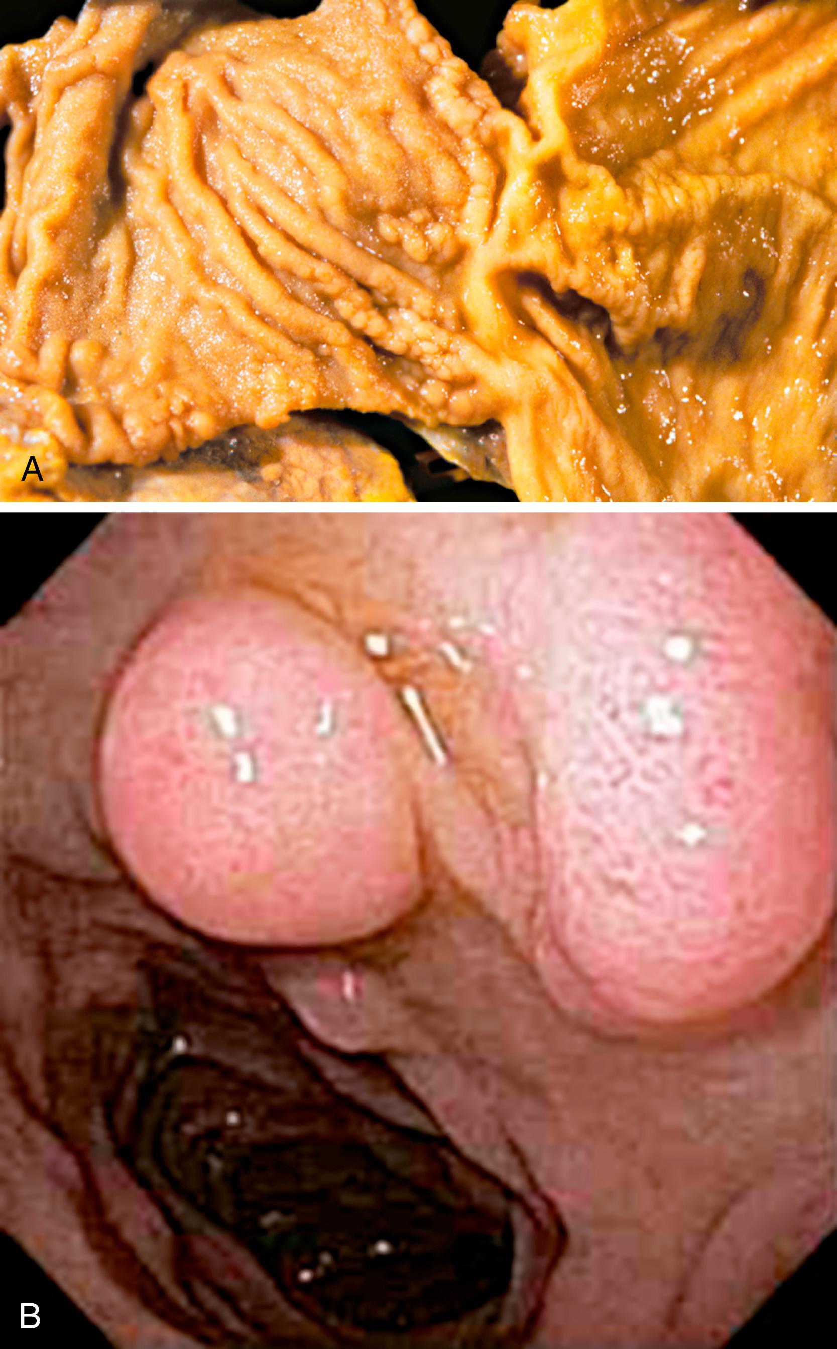 FIGURE 21.5, Brunner gland hyperplasia. Numerous polypoid excrescences are present within the duodenal bulb, imparting a nodular quality to the mucosal surface in a resection specimen (A), which may be endoscopically apparent (B).