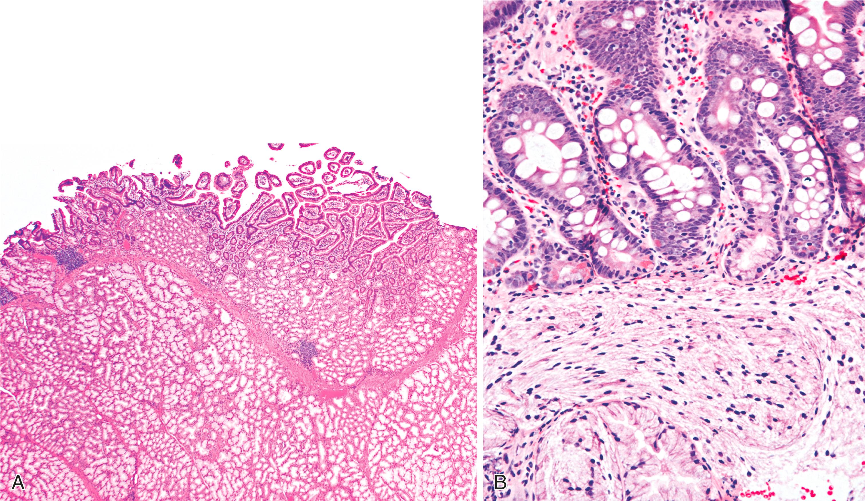 FIGURE 21.6, Brunner gland hyperplasia. A, At low power, lobules of Brunner glands expand the submucosa, extending into and filling the lamina propria. The hyperplastic Brunner glands are separated by delicate fibrous septa. B, Brunner glands may become artifactually distorted and contain spindled, compressed epithelial cells.