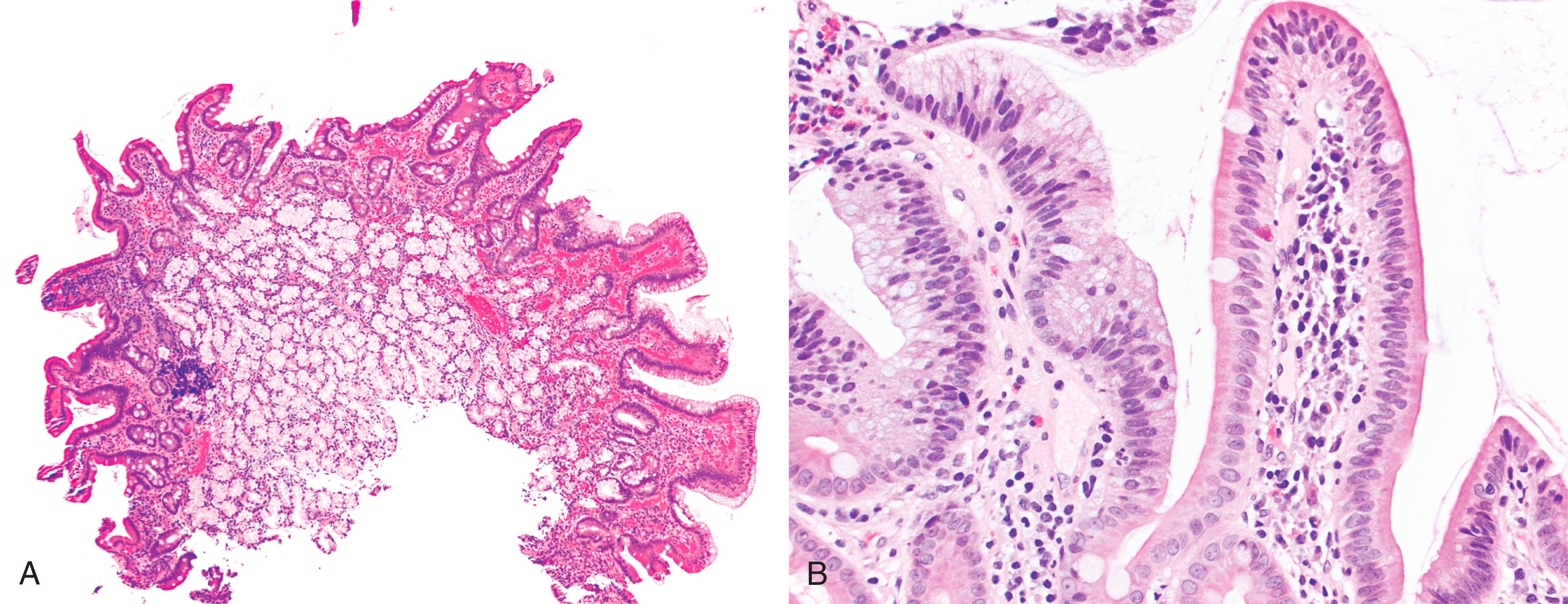 FIGURE 21.7, Nodular peptic-type duodenitis. A, Hyperplastic Brunner glands fill the lamina propria, imparting a nodular appearance to the mucosa. Partial villous shortening and increased lamina propria chronic inflammation are also seen, indicative of duodenitis. B, Foveolar-type metaplasia is present on the villous surface of the duodenum. In contrast with the absorptive and goblet cells, the metaplastic cells contain small apical vacuoles, similar to gastric foveolar cells.