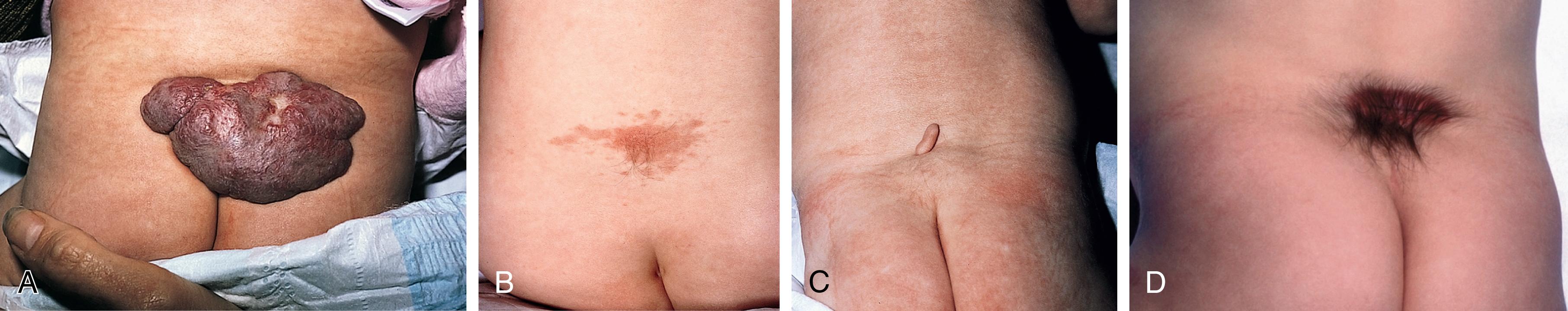 Fig. 58.3, Clinical aspects of congenital median lumbosacral cutaneous lesions. A, Midline sacral hemangioma in a patient with an occult lipomyelomeningocele. B, Capillary malformation with a subtle patch of hypertrichosis in a patient with a dermal sinus. C, Human tail with underlying lipoma in an infant with lipomyelomeningocele. D, Midline area of hypertrichosis (faun tail) overlying a patch of hyperpigmentation.