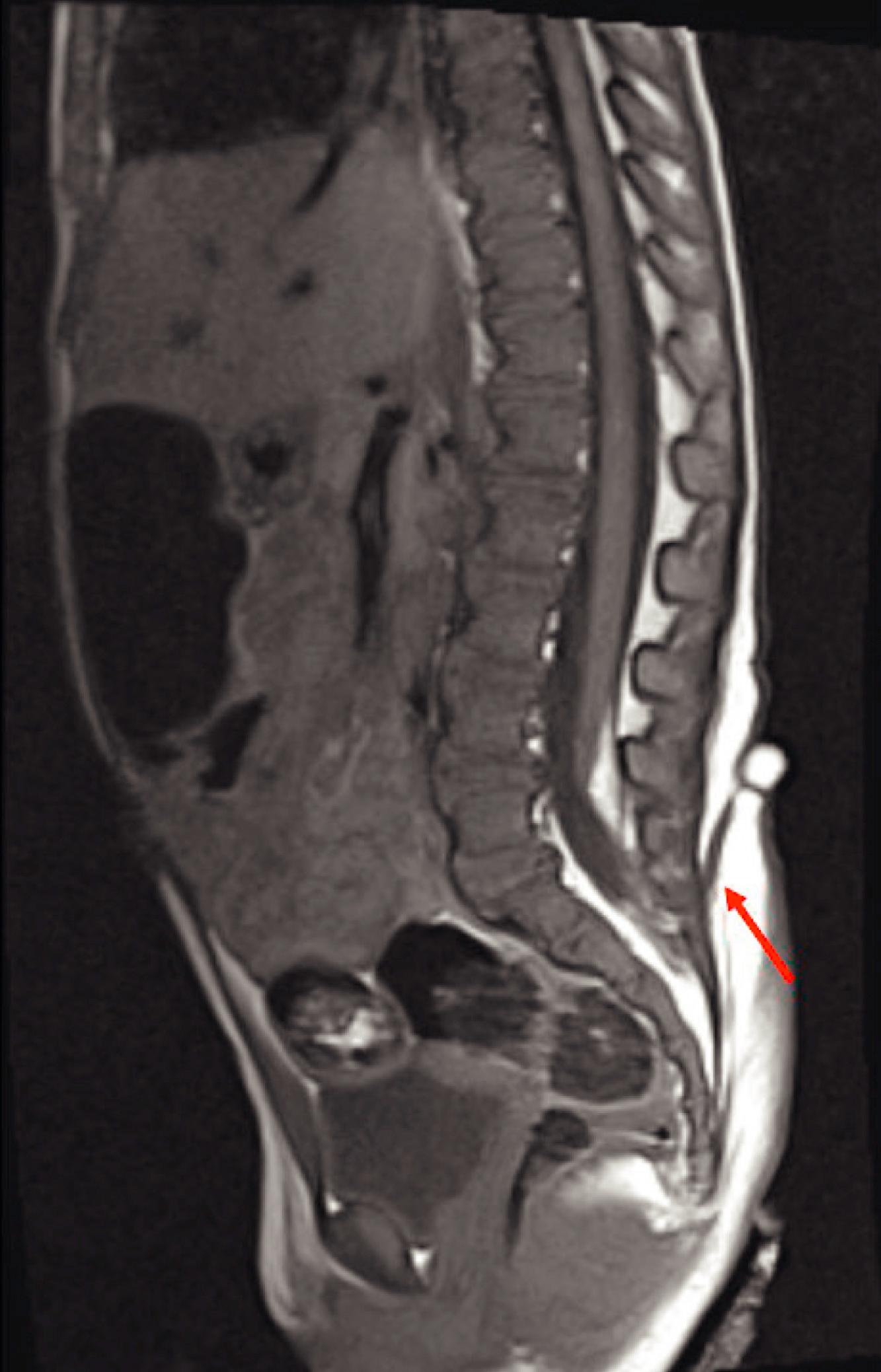 Fig. 58.4, Dermal sinus tract—similar to a lipomyelomeningocele but with an additional fibrous tract (red arrow) extending from a superficial skin dimple to the placode.