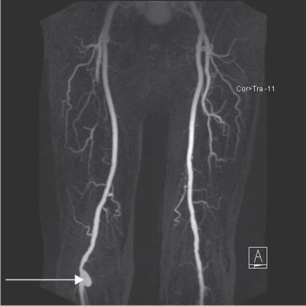 Figure 49, Femoral angiogram of a patient who presented with a pulsatile, expansile swelling in the right popliteal fossa .