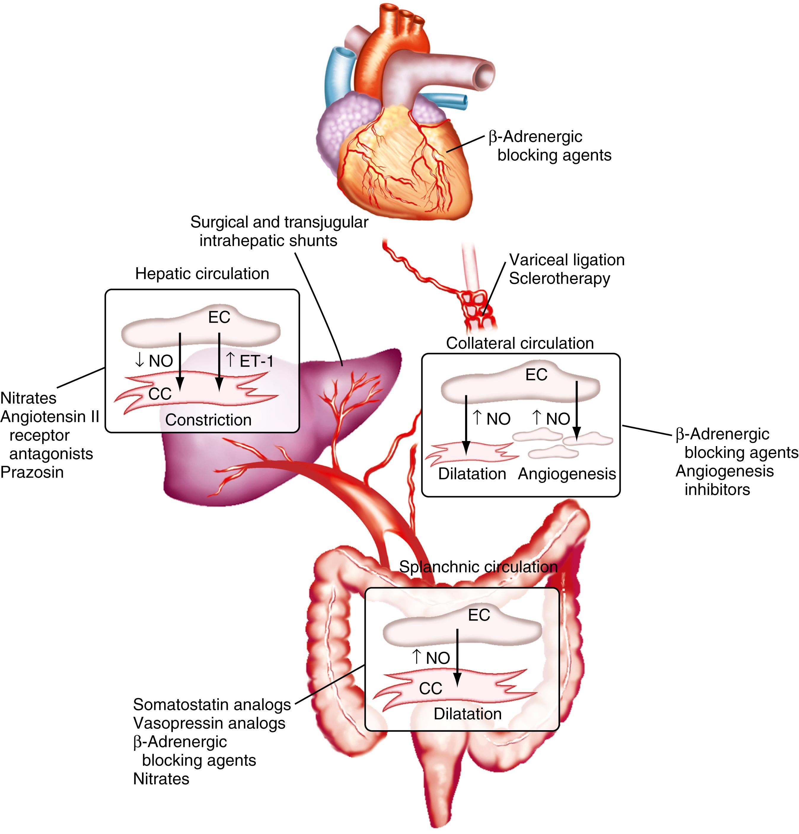 Fig. 92.3, Vascular disturbances in portal hypertension and sites of action of portal pressure-reducing therapies. Portal hypertension typically results from increased resistance, usually from within the liver, in combination with increased portal venous flow. The increase in hepatic resistance results from mechanical factors in combination with dynamic vasoconstriction mediated by decreased nitric oxide (NO) production and increased endothelin-1 (ET-1) production. The increase in portal venous flow occurs as a result of vasodilatation in the splanchnic circulation that is mediated by increased NO production. A collateral circulation, including esophageal varices, develops between the hypertensive portal vasculature and systemic venous system; however, these collaterals are inadequate to decompress the hypertensive portal circulation fully. Collateral vessel development is mediated by dilatation of existing collateral vessels, as well as the development of new blood vessels and sprouts (angiogenesis). Therapies aimed at the different sites of hemodynamic disturbances are shown. CC, contractile cell (e.g., hepatic stellate cell, vascular smooth muscle cell); EC, endothelial cell.