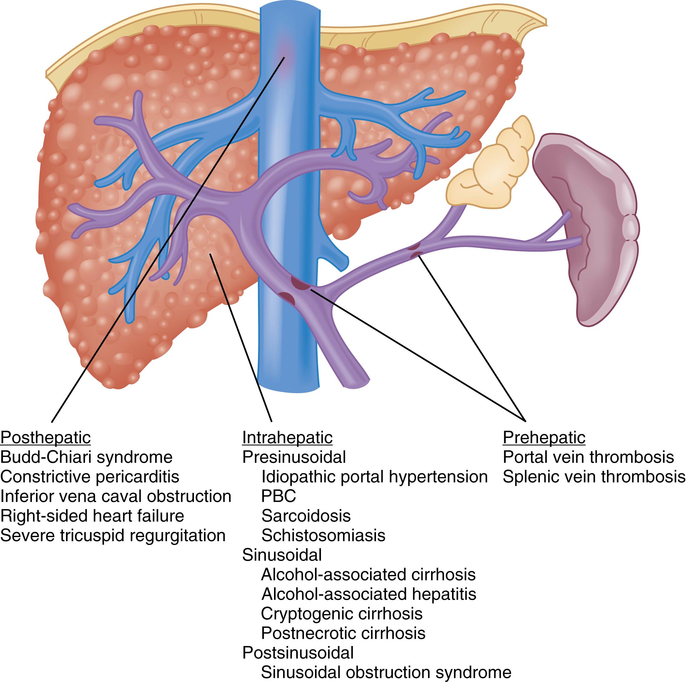 Fig. 92.5, Classification of portal hypertension. The different sites of increased resistance to portal flow (posthepatic, intrahepatic, and prehepatic) and associated diseases are shown. Many diseases cause a mixed pattern. Portal hypertension rarely can occur exclusively as a result of increased portal blood flow, as occurs with an arteriovenous shunt (not shown).