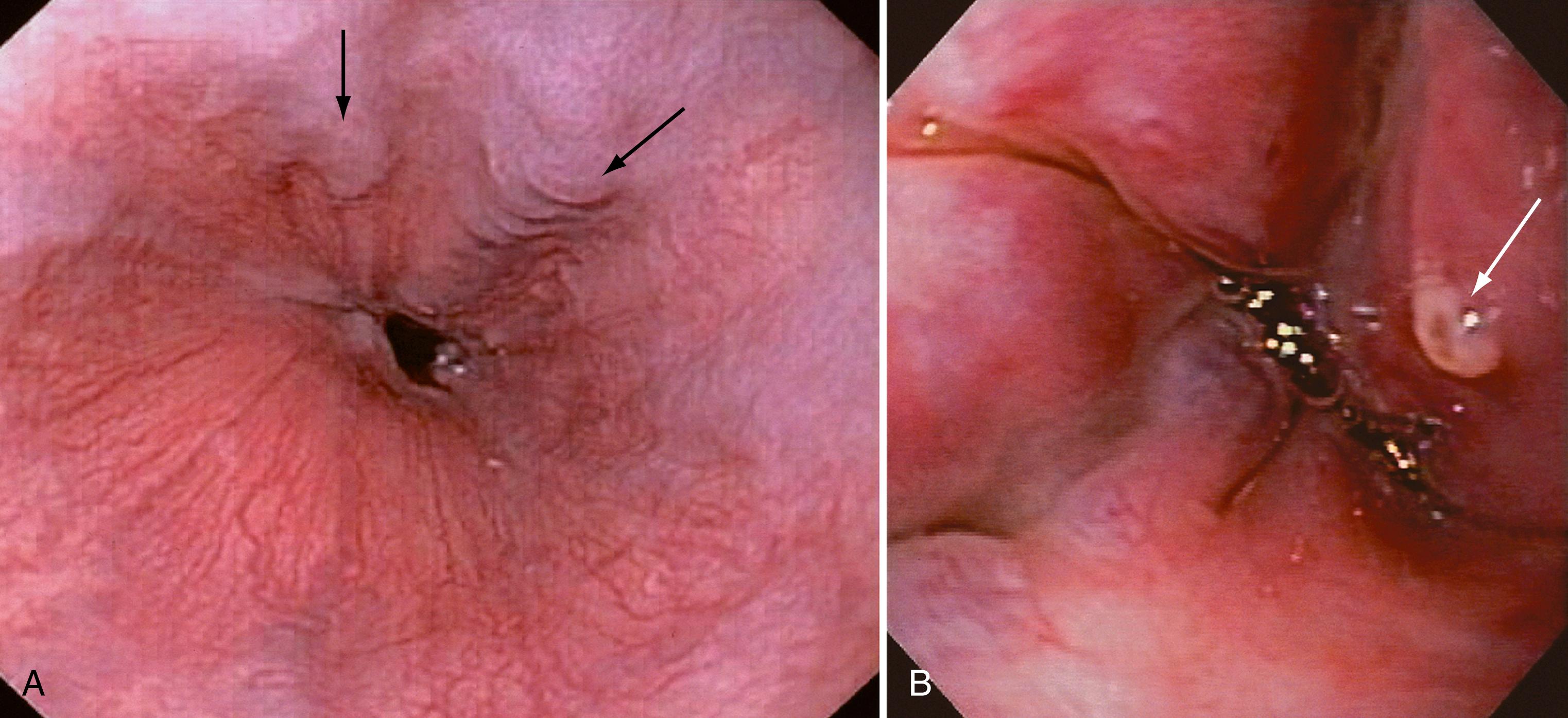 Fig. 92.6, Endoscopic appearances of esophageal varices. A, EGD demonstrating dilated and straight veins (small esophageal varices) in the distal esophagus (arrows) . B, EGD demonstrating large esophageal varices, greater than 5 mm in diameter, with a fibrin plug (arrow) indicating the site of a recent bleed.