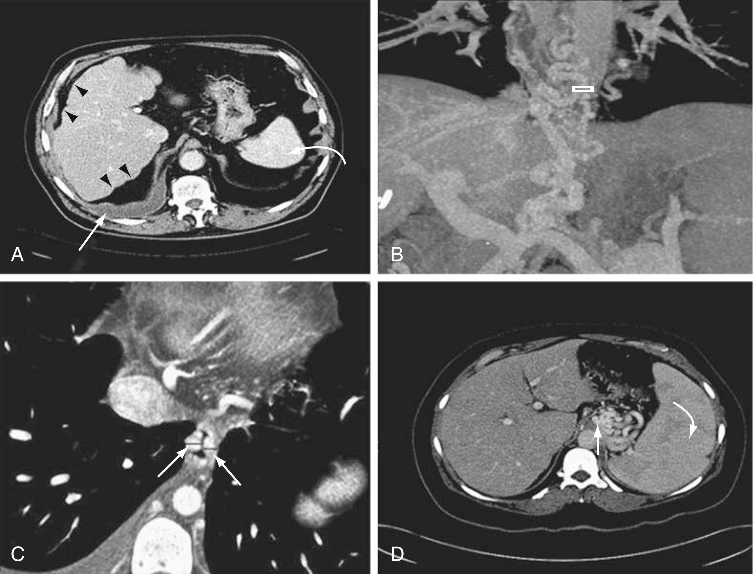 Fig. 92.7, Abdominal CT in patients with portal hypertension. A, Image showing an irregular contour of the liver (arrowheads) typical of cirrhosis. A small right pleural effusion is evident (straight arrow) . The liver is hypointense relative to the spleen (curved arrow) , typical of fatty infiltration of the liver in alcohol-associated cirrhosis. B, Coronal section of a CT showing contrast-enhanced esophageal varices (cursor) . C, Image showing 2 large esophageal varices (arrows) 5 mm and 6 mm in diameter. Varices are almost opposed to each other. D, Image showing a tuft of gastroesophageal collaterals (straight arrow) . The enlarged spleen is also seen (curved arrow) .