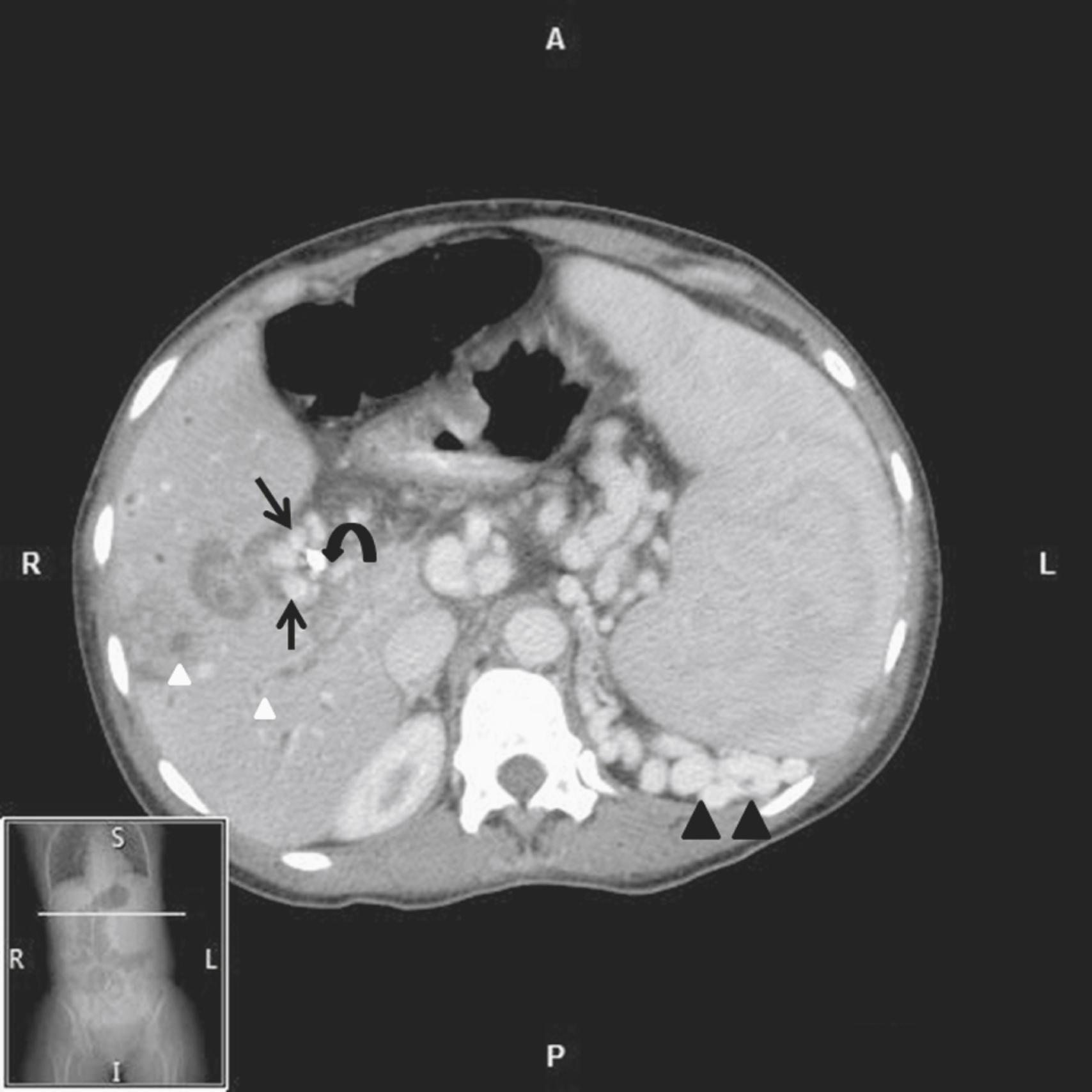 Fig. 92.8, CT showing choledochal varices (straight arrows) surrounding a stent in the bile duct (curved arrow) .