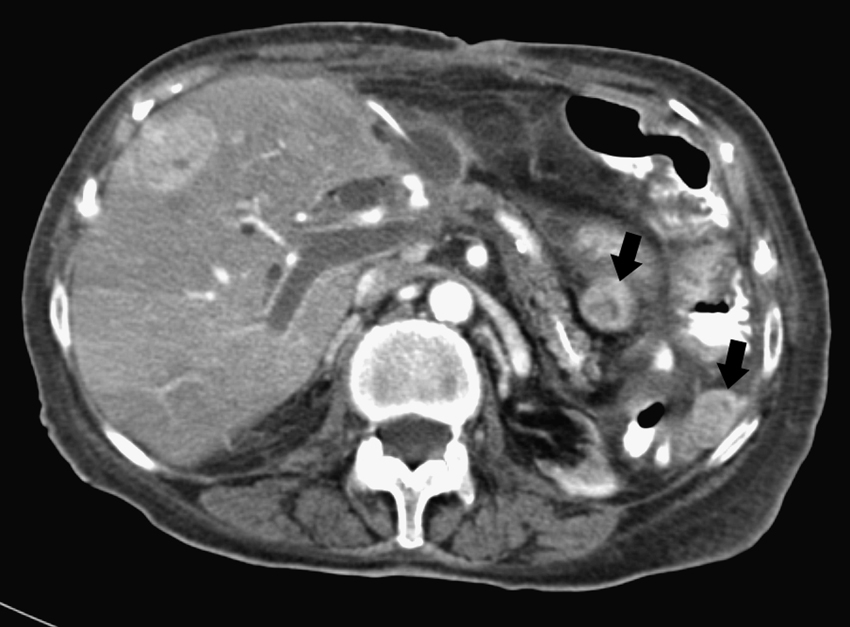 Fig. 71.2, Mesenteric sarcoma in 75-year-old woman required multiple abdominal surgical interventions, including cephalic duodenopancreatectomy. Contrast-enhanced multislice computed tomography in portal phase shows hypodense thrombus distending portal vein, with portal vein wall enhancement and heterogeneity in enhancement of hepatic parenchyma. Hypervascular hepatic and peritoneal ( arrows ) metastases, pancreatic duct stent, and left renal atrophy are also seen.