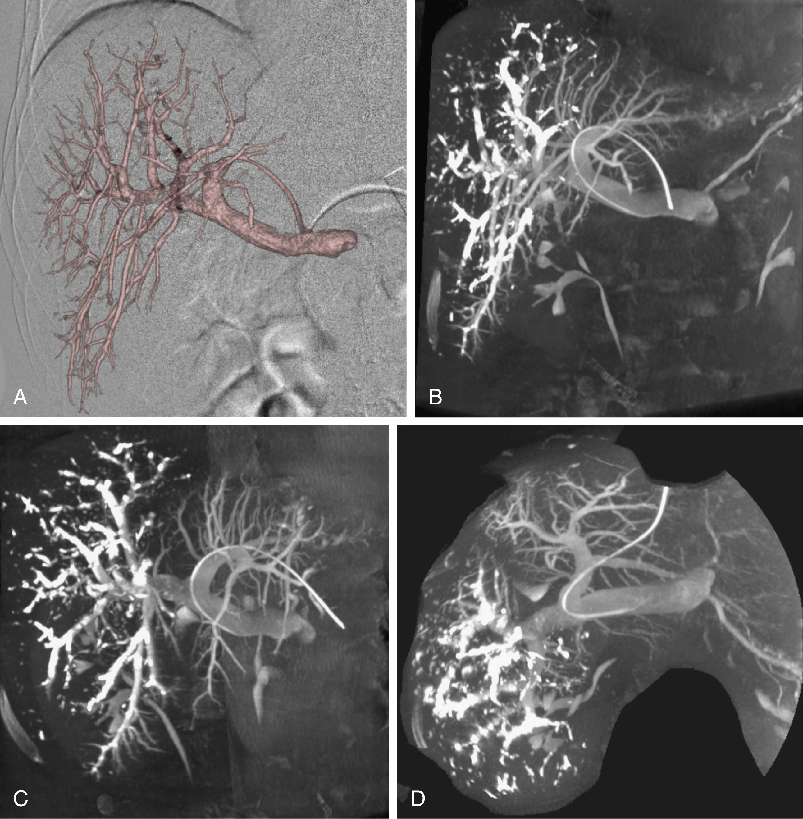 Fig. 37.1, (A) Three-dimensional reconstruction of the portal tree from cone-beam computed tomography acquisition. Multiplanar reconstruction in the frontal (B), frontal oblique (C), and axial plane (D) obtained after portal vein embolization of the right liver where glue is demonstrated in branches feeding the segments V, VI, VII, and VIII. Notice the segment III contralateral puncture without embolization of segment IV.