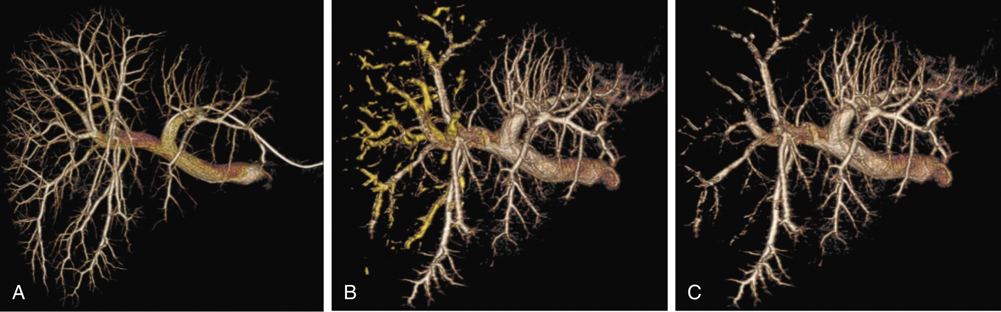 Fig. 37.2, (A) Frontal view of 3D reconstruction of the portal tree from cone-beam computed tomography (CT) acquisition before portal vein embolization (PVE) demonstrates portal vein anatomy. (B) Atypical PVE to right posterior segment (segments VI and VII) has been performed and the right anterior oblique reconstruction obtained from cone-beam CT portography shows the glue in yellow and patent branches in brown. (C) Right anterior oblique reconstruction where glue is subtracted shows the patent branches to all liver except the right posterior segment.