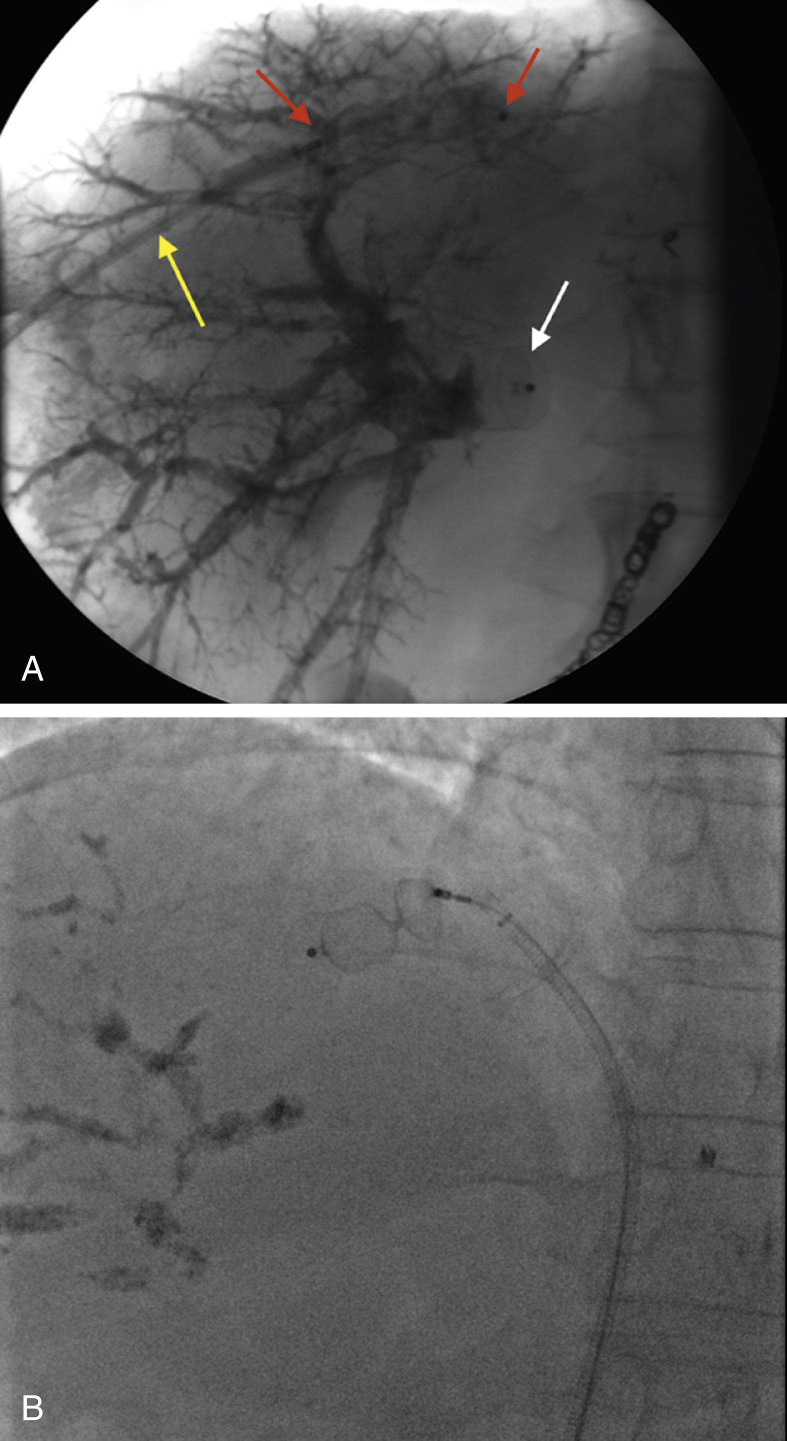 Fig. 37.3, Venous liver deprivation (portal vein embolization associated with hepatic vein embolization). In patient A, the access to the right hepatic vein has been obtained percutaneously with a plug in the right portal vein ( white arrow ) and a plug in the right hepatic vein ( red arrows ) while the delivery system is still in place ( yellow arrow ). In patient B, the access has been obtain through a right femoral access, and the delivery device is seen in the vena cava, while the plug is delivered to the right hepatic vein. Notice the glue in the right portal branches.