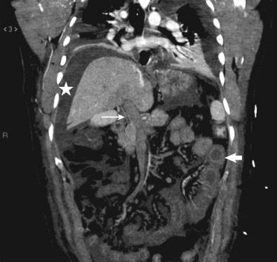 Fig. 45-1, Computed tomography scan in a patient with acute portomesenteric vein thrombosis. Coronal computed tomography scan in the portal phase shows portomesenteric vein thrombosis ( arrow ), with thickening of the bowel wall ( arrowhead ) and ascites ( star ).