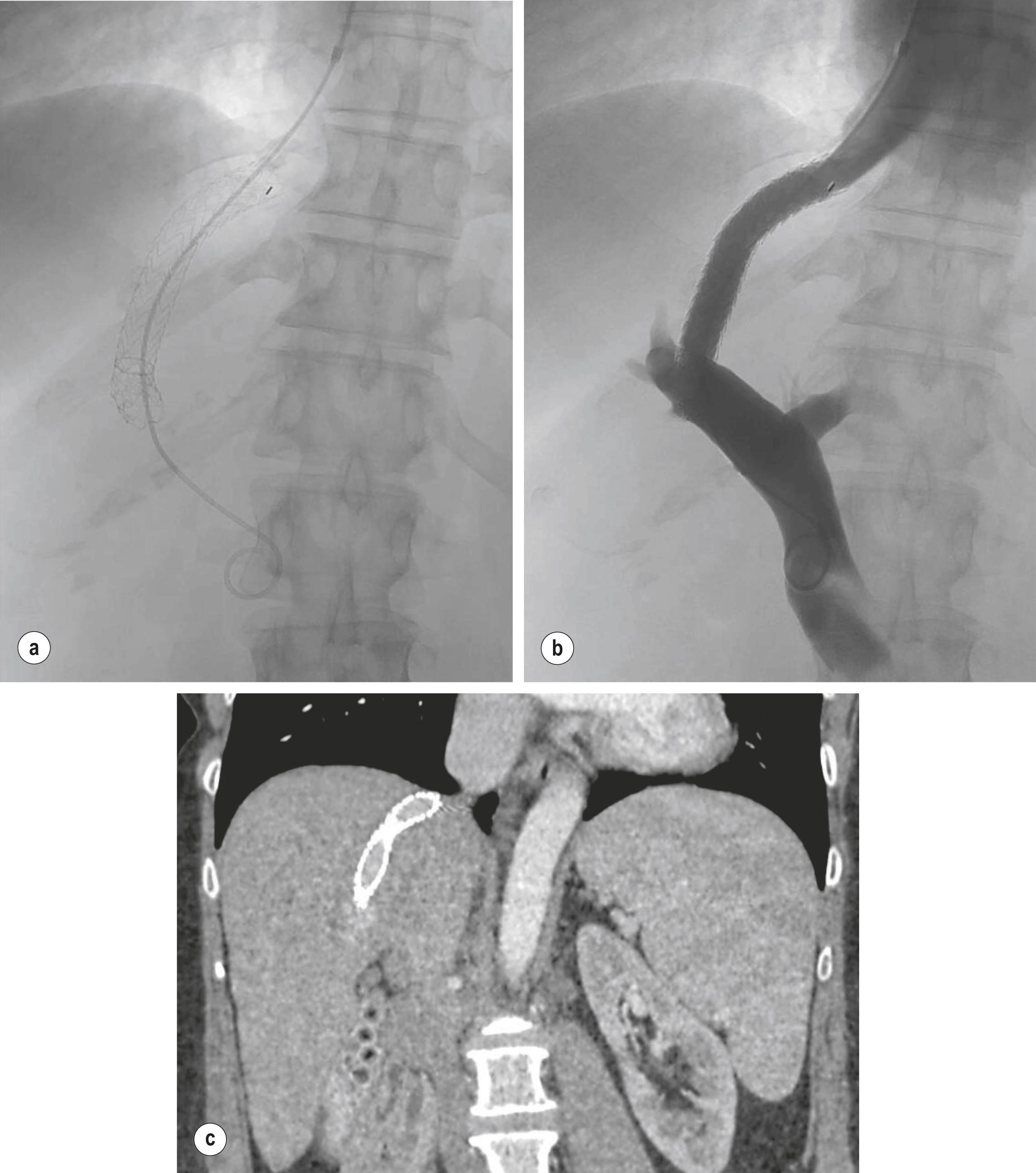 Figure 9.2, Transjugular portosystemic shunt (TIPSS/TIPS). (a) Stent placement from hepatic vein, through liver parenchyma to portal vein. (b) Venogram confirming stent patency and diversion of portal venous blood flow. (c) Post-procedural CT scan.