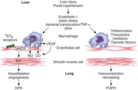 FIGURE 39-1, Pathophysiology of hepatopulmonary syndrome (microvascular dilatation and angiogenesis) and portopulmonary hypertension (vasoconstriction and remodeling in resistance vessels). CO , Carbon monoxide; eNOS , endothelial nitric oxide synthase; ET B , endothelin B; HO-1 , heme oxygenase-1; HPS , hepatopulmonary syndrome; iNOS , inducible nitric oxide synthetase; NO , nitric oxide; POPH , portopulmonary hypertension; TNF-α , tumor necrosis factor-α; VEGF , vascular endothelial growth factor.