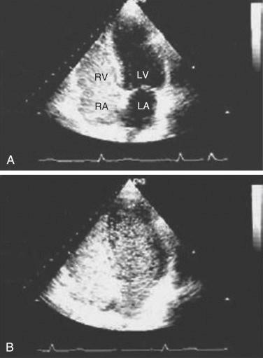 FIGURE 39-5, Transthoracic echocardiographic features of the hepatopulmonary syndrome. The chambers of the right heart are initially opacified with microbubbles ( A ), followed by delayed opacification of the left heart ( B ). LA , Left atrium; LV , left ventricle; RA , right atrium; RV , right ventricle.