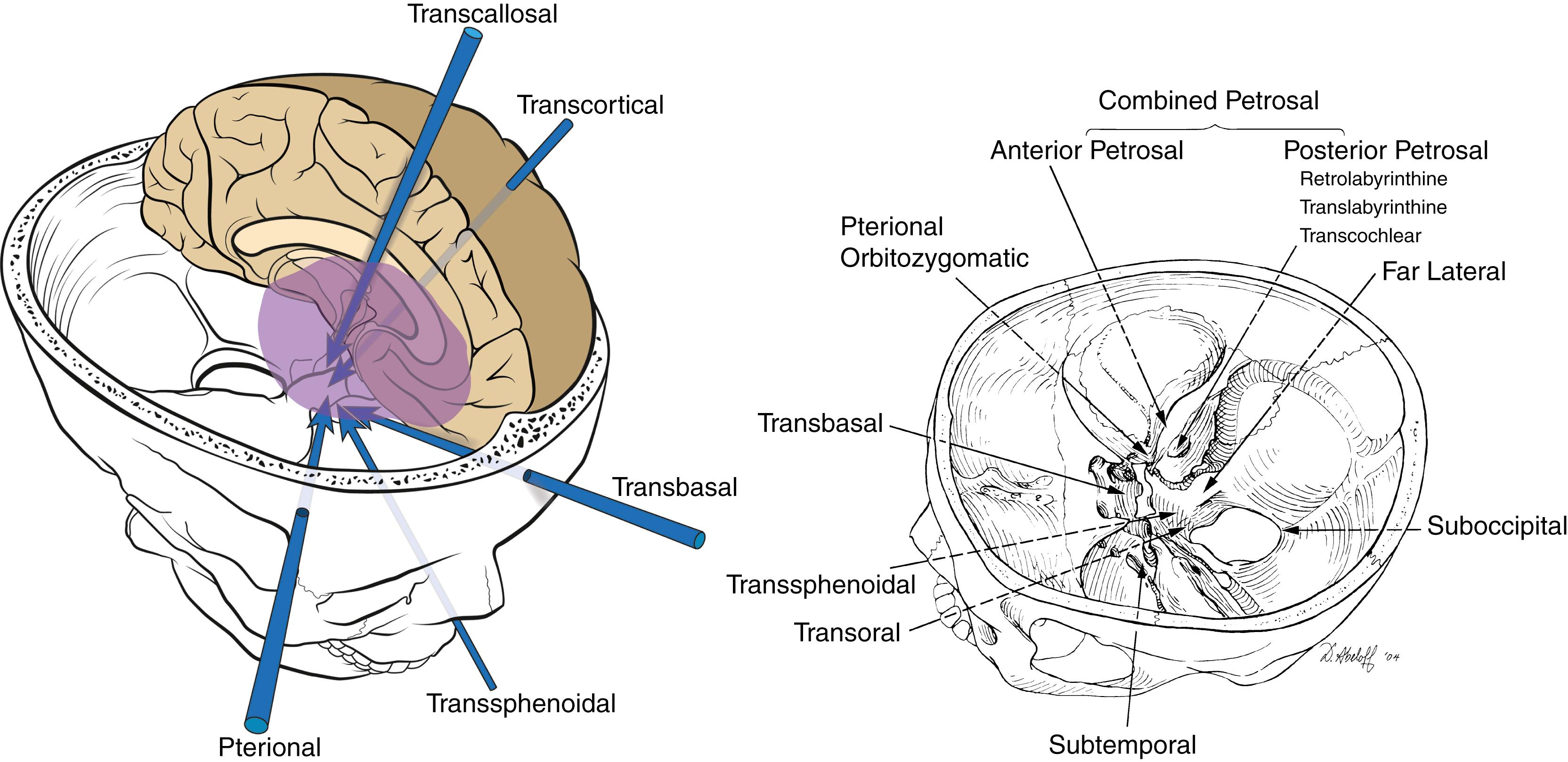 Figure 24.1, Artists’ illustrations showing the skull base with different corridors allowed by the different approaches.