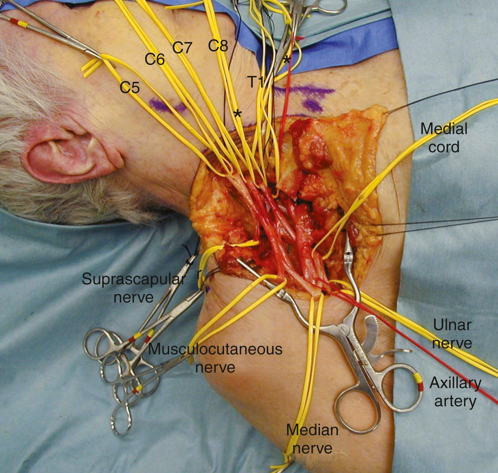 Figure 26.3, The full plexus exposed.