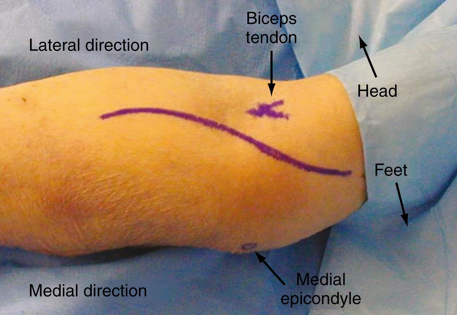 Figure 26.4, The incision site for exposure of the anterior interosseous nerve.
