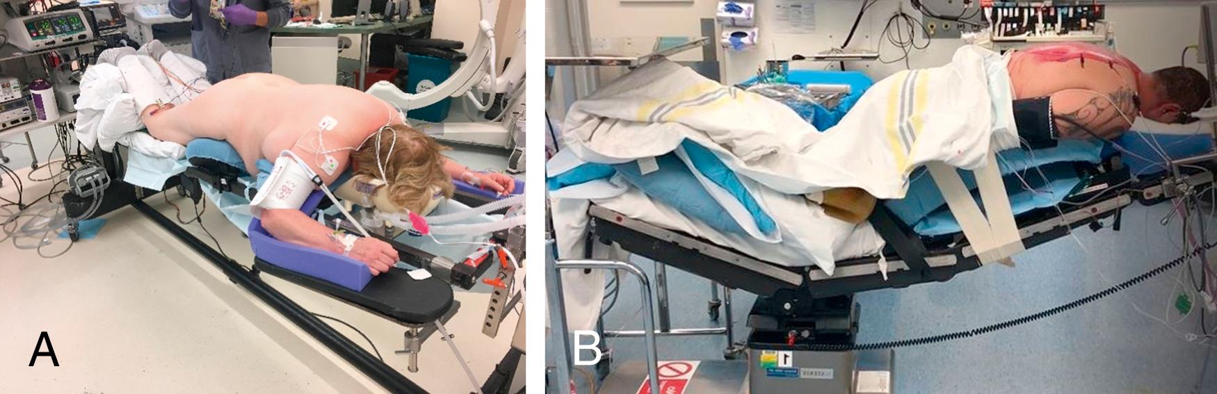 Figure 25.5, The prone superman position is demonstrated in this patient undergoing posterior thoracolumbar instrumentation on a Jackson table system (A). The patient’s head is supported by a foam protective helmet (ProneView) to avoid direct ocular pressure. Approximately 10 degrees of reverse Trendelenburg positioning is recommended while maintaining the head above the level of the heart. The patient’s head is in the neutral forward position, avoiding excessive cervical flexion/extension, lateral flexion, or rotation. Note that the upper extremities are placed on padded arm boards, the shoulders are abducted, and each elbow is flexed less than 90 degrees. Final patient positioning should avoid depressing the shoulder girdle, and the longitudinal axis of the forearm should be approximately parallel with the longitudinal axis of the patient. Next, the prone position with arms tucked is demonstrated in this patient undergoing upper thoracic decompression on a Wilson frame (B). We tuck the arms for spinal pathology cranial to the T6–T7 level.