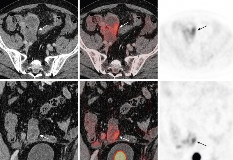 Figure 12-1, Value of precise localization and complementary strengths. Appendiceal adenocarcinoma. Markedly dilated appendix with thick wall and communication with cecum shows increased fluorodeoxyglucose uptake (arrows) along its wall. Without the positron emission tomography (PET) findings, the computed tomography (CT) finding might have been overlooked with the dilated appendix mimicking a large bowel loop. Without the CT findings, the PET activity could not have been precisely localized and possibly may have been misinterpreted as physiologic bowel activity.