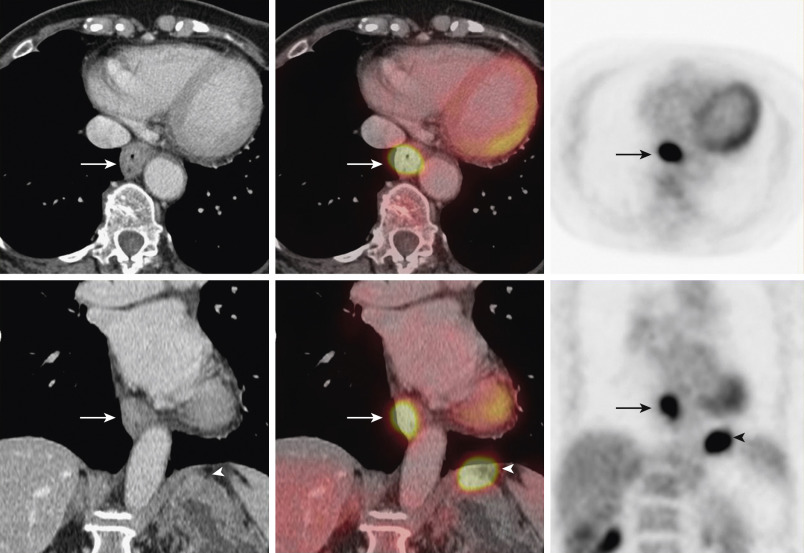 Figure 13-2, Esophageal cancer. Focal fluorodeoxyglucose (FDG) uptake in lower esophagus corresponding to esophageal thickening (arrows), representing an esophageal adenocarcinoma with a left diaphragmatic FDG-avid metastatic lymph node (arrowheads).