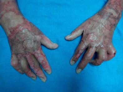 Fig. 4.11.1, Scarred hands from burn injury. Delayed or poor wound management contributes to development of these contractures and can severely limit a patient's ability to perform basic activities of daily living.