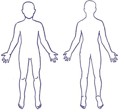 Fig. 4.11.2, A body figure diagram is used in wound assessment to better document location and extent of burns. Regular reassessments help track the progress of a patient's wound healing.