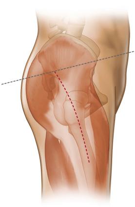 Fig. 17.1, Illustration demonstrating the outer sheath of the hip joint muscles, including the gluteus maximus, fascia lata, and tensor fascia lata.