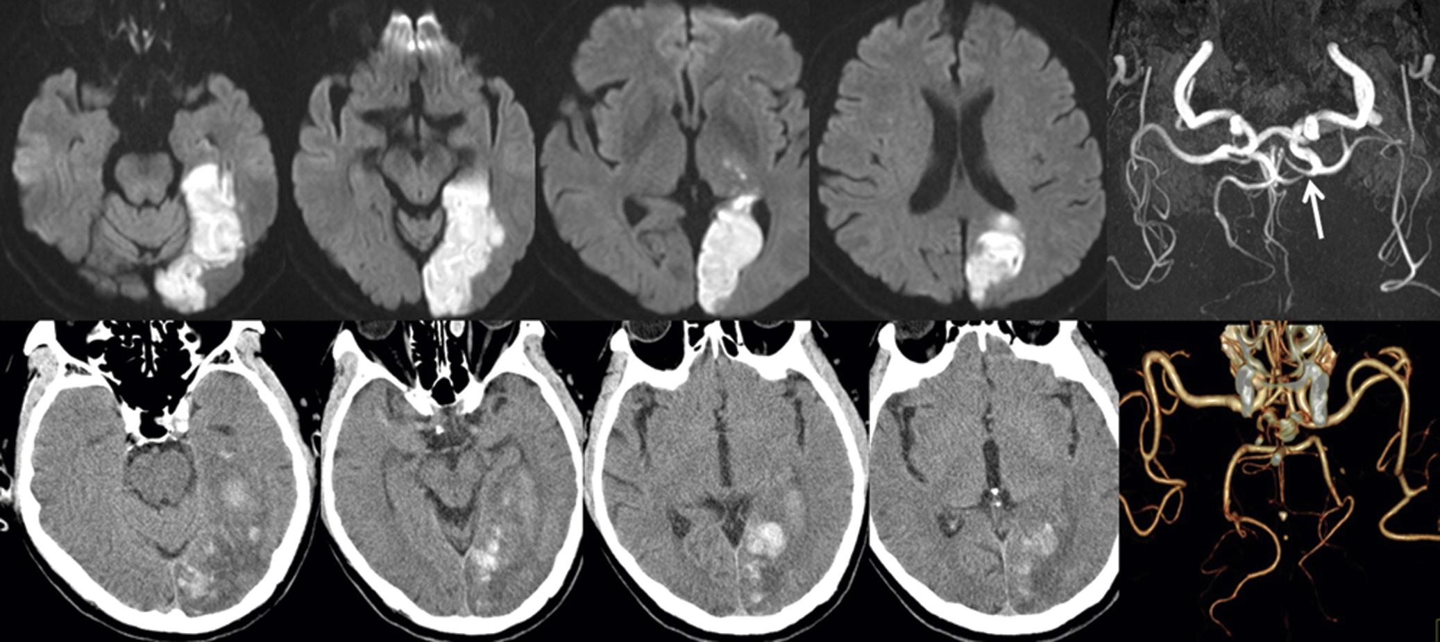 Fig. 25.11, A 75-year-old man with atrial fibrillation suddenly developed occipital headache followed by visual field defect and tingling sensation in the right limbs. Examination showed mild sensory deficits in the right face and limbs, and dense right homonymous hemianopia. He was able to write but could not read what he wrote (alexia without agraphia). Diffusion-weighted MRI showed acute infarcts in the left occipital lobe and the lateral thalamus (upper row) . MR angiogram showed occlusion of the left posterior cerebral artery (arrow) (last image in the upper row ). During admission, the patient complained of progressively worsening occipital headache. CT performed 7 days later showed hemorrhagic transformation (lower row) . CT angiogram revealed recanalized posterior cerebral artery (last image in the lower row ).