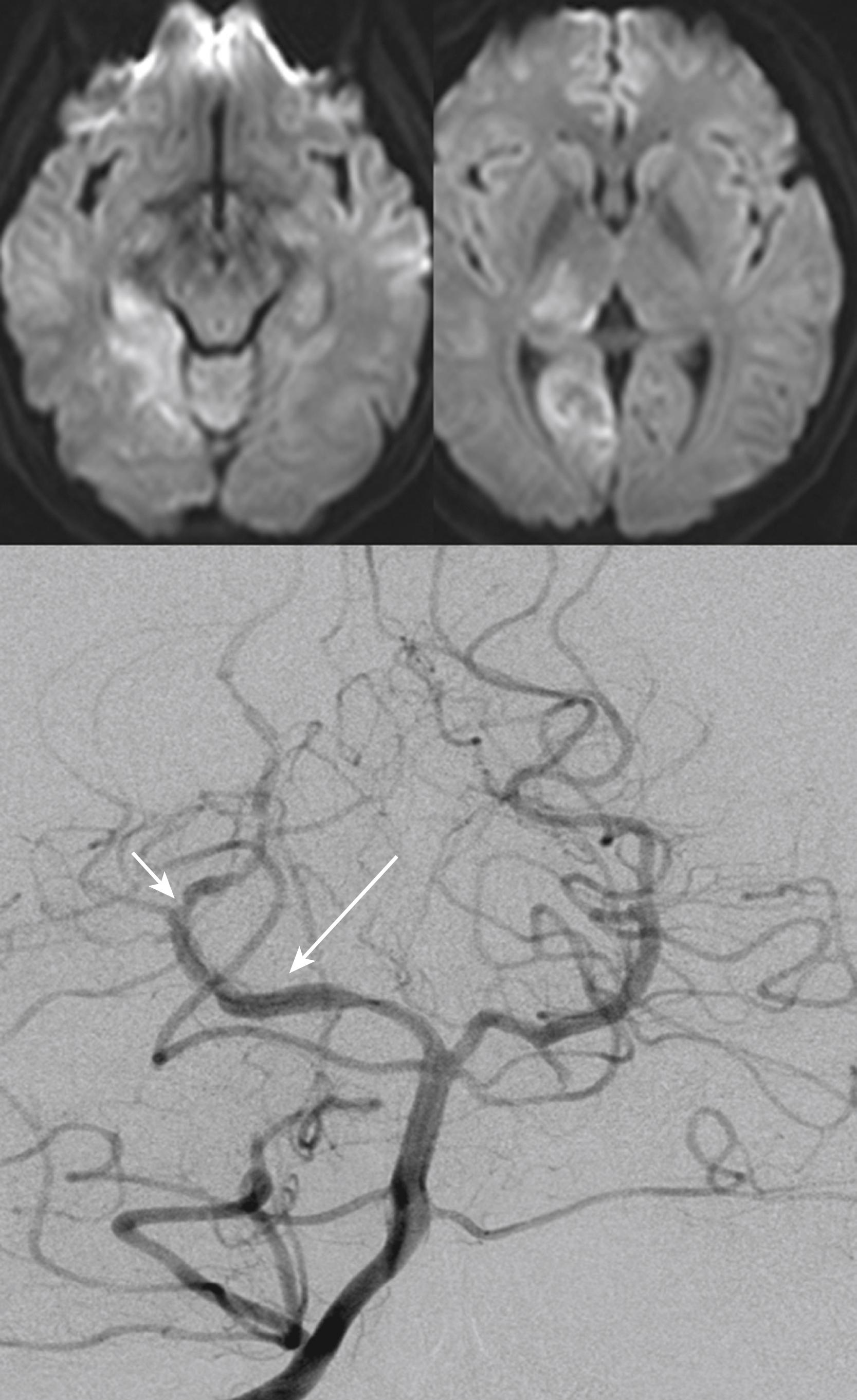 Fig. 25.12, A 32-year-old woman suddenly developed tingling sensation in the left limbs and visual field defect. Examination showed impaired sensory perception in the left face and limbs, mild ataxia, and dense left homonymous hemianopia. Diffusion-weighted MRI showed acute infarcts in the right lateral thalamus and occipital lobe (upper row) . Conventional angiogram showed diffuse, fusiform dilatation (long arrow) and stenosis (short arrow) of the posterior cerebral artery (lower row) . The angiographic findings were unchanged after 3 months. Vasculitis workups were all negative, and the most likely diagnosis was dissection.