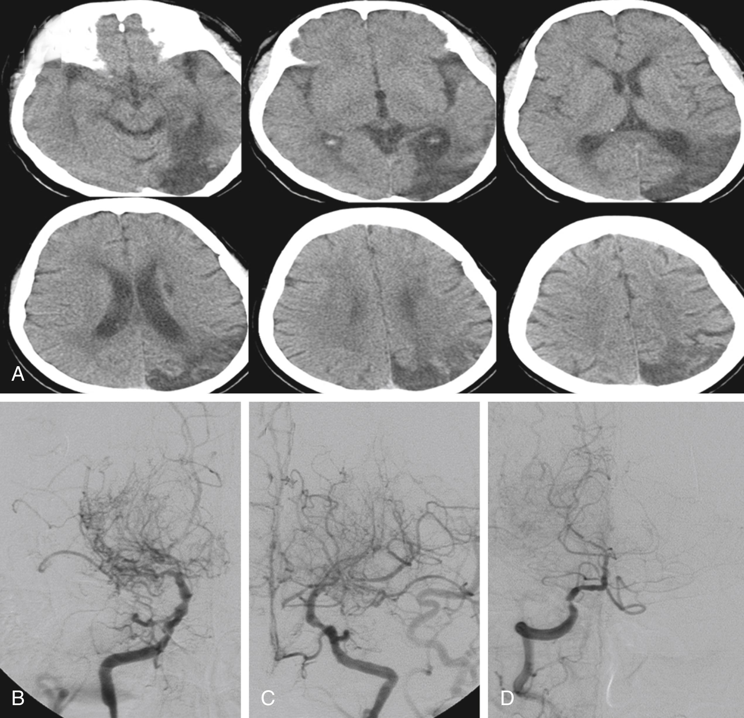 Fig. 25.13, A 64-year-old woman developed visual field defect on the right side. CT shows an infarct in the left occipital area that extends to the borderzone area between the posterior cerebral artery and middle cerebral artery. Asymptomatic subcortical infarcts are also shown on the left side (A). Angiogram showed bilateral occlusion of distal internal carotid arteries and numerous basal moyamoya vessels. Posterior circulation was also involved and left posterior cerebral artery was occluded (B–D).