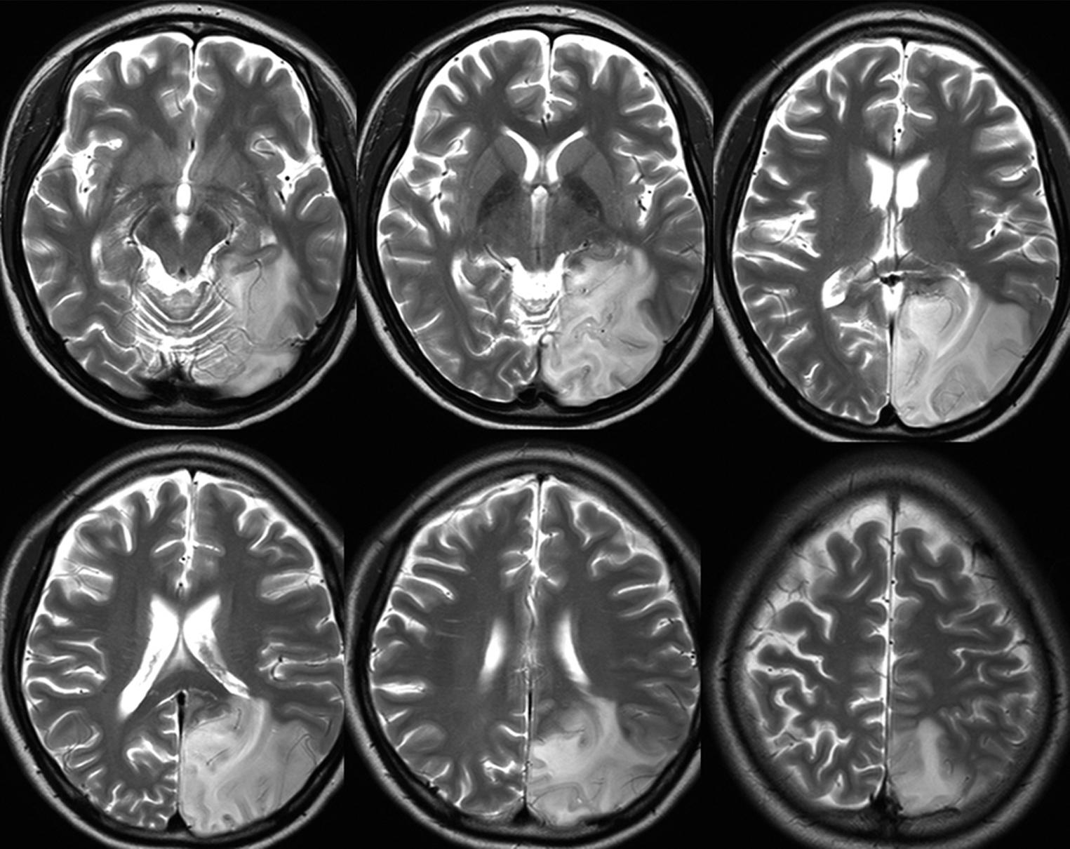 Fig. 25.14, A 17-year-old girl felt that she could not clearly see objects on the right side 2 months before admission. She had had hearing difficulty and recurrent episodes of generalized seizures. Examination showed dense right homonymous hemianopia. There was serum lactic acidosis, and genetic studies revealed mitochondrial gene (3243A>G) mutation. She was diagnosed as having MELAS (mitochondrial encephalomyopathy, lactic acidosis, and stroke-like episodes). T2-Weighted MRI showed a large left occipital infarction that extended beyond the usual posterior cerebral artery territory.