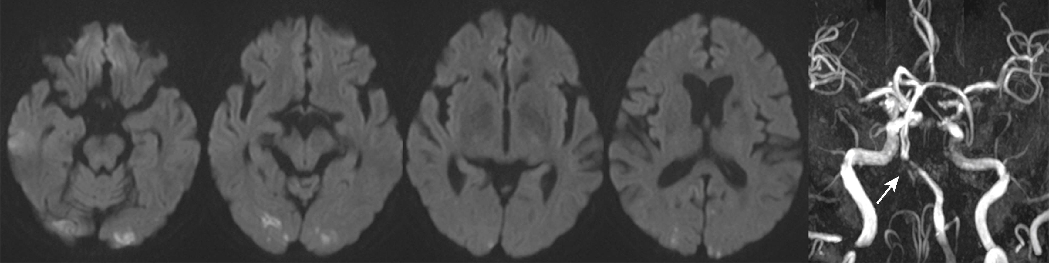 Fig. 25.3, A 70-year-old woman who had hypertension and diabetes mellitus suddenly complained of dim vision. She also reported several dark spots in the visual field. The symptoms disappeared in 3 days. Diffusion-weighted MRI (first 4 images) show bilateral, scattered occipital infarcts. MR angiogram (right image) shows a severe, focal atherosclerotic stenosis in the left vertebrobasilar artery junction (arrow) that probably generates artery-to-artery embolism. There was a hypoplasia in the right vertebral artery.