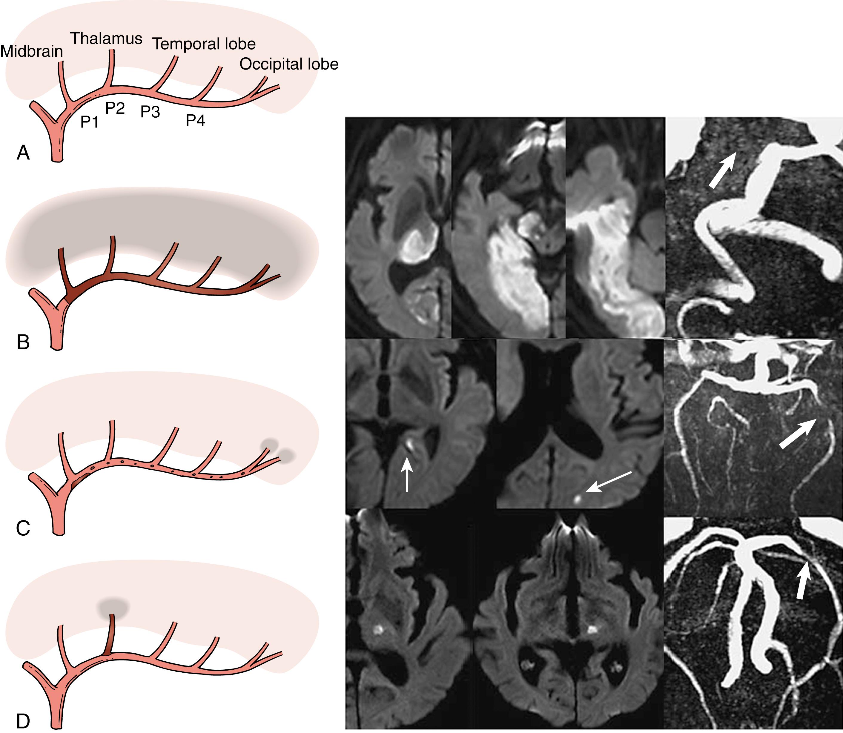 Fig. 25.4, Schematic drawing and illustrative examples of the diverse patterns of posterior cerebral artery (PCA) territory infarction due to PCA atherothrombosis, as assessed by diffusion-weighted MRI and MR angiography. The stenosis or occlusion of PCA shown in these patients was persistent on follow-up MR angiography. (A) Schematic drawing illustrating PCA branches supplying midbrain, thalamus, and temporo-occipital area. (B) In situ thrombotic occlusion; whole right PCA territory infarction is produced by the right P1 occlusion (arrow) . (C) Artery-to-artery embolism; the severe atherosclerotic stenosis in the left P2 portion of the PCA P2 (thick arrow) presumably generates emboli that cause multiple small infarcts (thin arrows) scattered in the occipital lobe. (D) Branch occlusion; mild atherosclerotic stenosis in the left P2 portion of the PCA (arrow) causes the left lateral thalamic infarction probably by occluding the orifice of the thalamogeniculate artery.