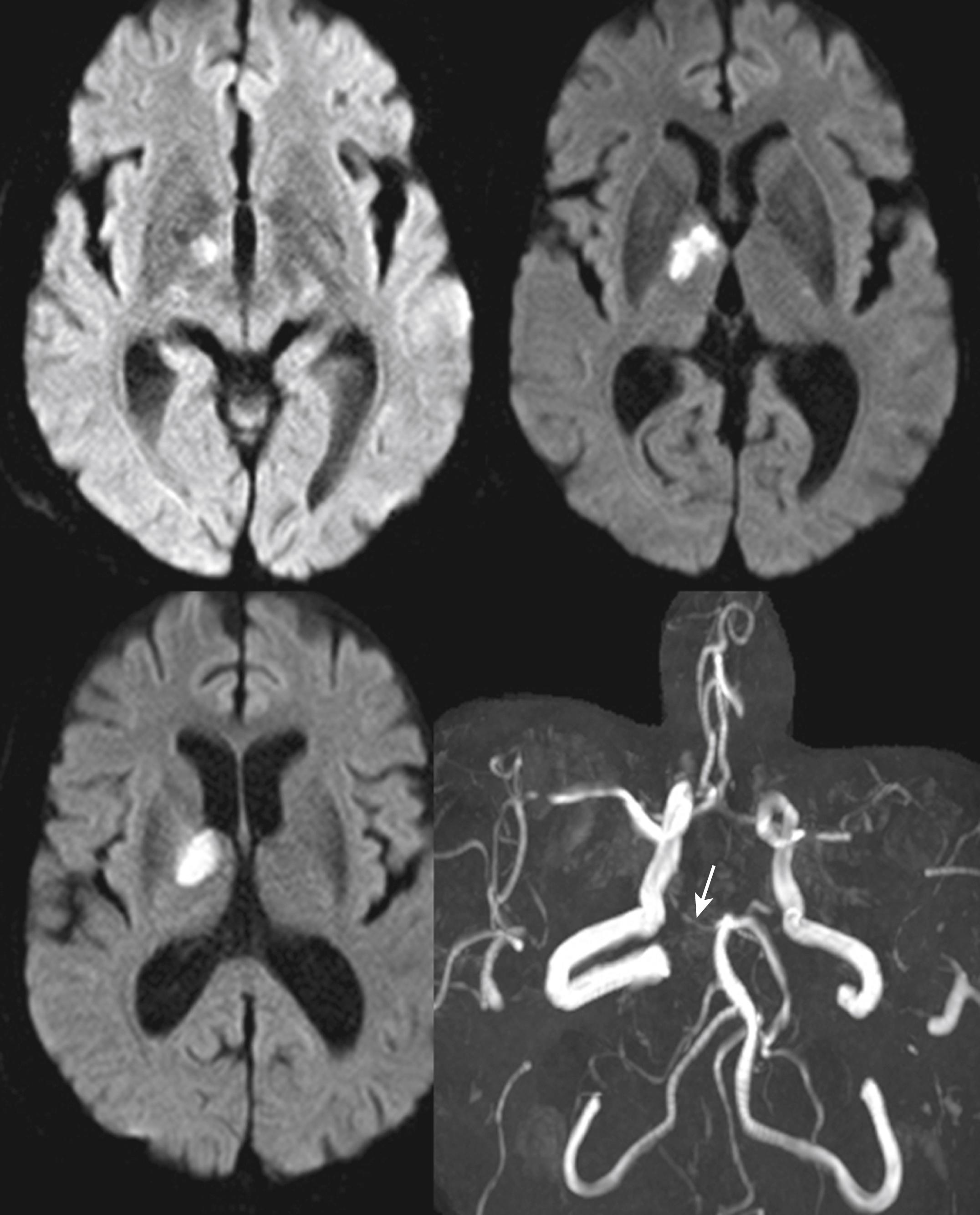 Fig. 25.5, A 76-year-old woman developed confusion and memory loss. Diffusion-weighed MRI showed an infarct in the anterior part of the right thalamus. MR angiogram showed complete occlusion of the P1 portion of the posterior cerebral artery (arrow) . There was bilateral middle cerebral artery atherosclerotic stenosis. Follow-up MR angiogram performed 4 days later showed identical findings (not shown).