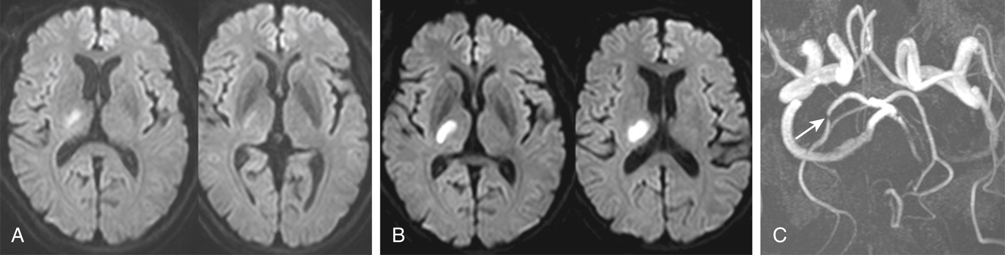 Fig. 25.6, A 66-year-old hypertensive man developed a tingling sensation in the left cheek and fingers. Examination showed slightly decreased perception of pain and touch in those areas, but without motor function abnormality. Diffusion-weighted MRI showed a small lateral thalamic infarction (A). After admission, the neurologic deficits progressively worsened, and 4 days later he had severe sensory deficits of all sensory modality in the left face and limbs. There developed mild left hemiparesis and ataxia. Follow-up MRI showed enlargement of the lesion (B). MR angiogram showed a focal atherosclerotic stenosis in the right P2 portion of the posterior cerebral artery (arrow) (C) that resulted in branch occlusion.