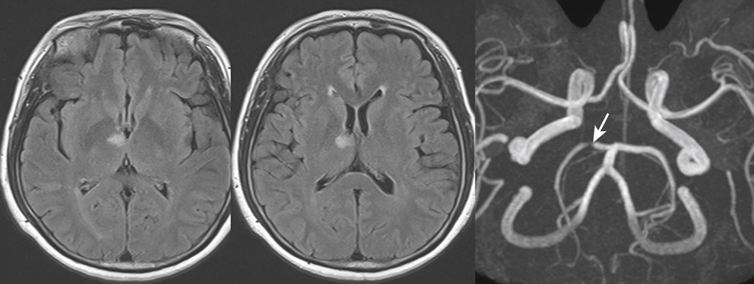 Fig. 25.7, A 56-year-old hypertensive woman suddenly had memory loss. Examination showed severe anterograde amnesia. Flair MRI showed right anterior thalamic infarct (first two images) . MR angiogram showed focal stenosis in the P1 portion of the right posterior cerebral artery (arrow) that probably produced branch occlusion (occlusion of the paramedian artery). Posterior communicating artery was not visible.