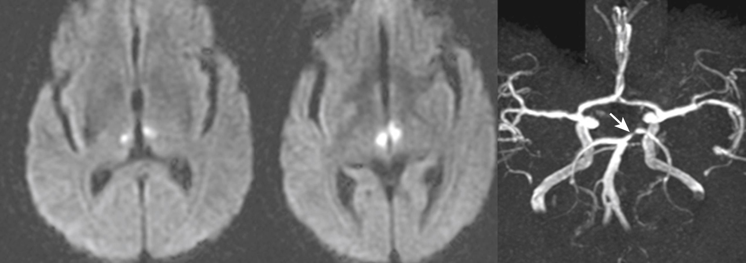 Fig. 25.8, A 64-year-old hypertensive woman became stuporous. Examination showed severe vertical gaze limitation and confused mentality. Diffusion-weighted MRI showed bilateral paramedian midbrain and thalamic infarcts. MR angiogram showed focal atherothrombotic stenosis in the P1 portion of the left posterior cerebral artery (arrow) . The focal thrombus at this portion probably occluded the pedicle of a paramedian artery (branch occlusion) that branches off to supply both parts of the paramedian midbrain and thalamus. There was a fenestration of the lower basilar artery.