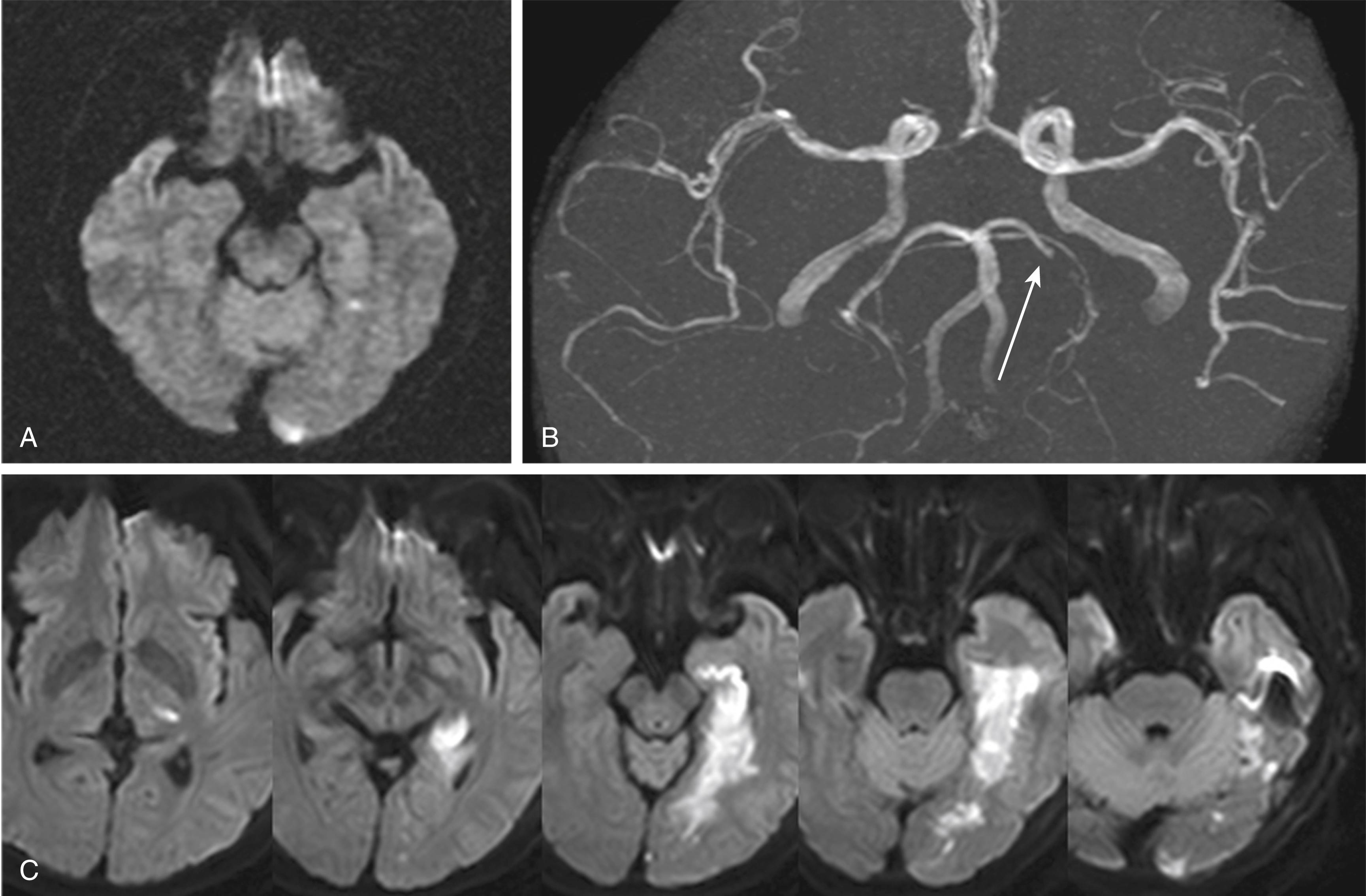 Fig. 25.9, A 60-year-old man with a history of hypertension, diabetes, and coronary heart disease had sudden blurred vision that was followed by clumsiness of the left hand. On examination, he showed right homonymous hemianopia, and slight weakness and moderately decreased sensation in the left arm and leg. Initial diffusion-weighted MRI showed a few scattered, tiny infarcts in the left medial temporal and occipital area (A). Initial MR angiogram showed occlusion of the P2 portion of the left posterior cerebral artery (B). Diffusion MRI taken one day later showed expansion of the lesion to the left lateral thalamus, medial temporal area, and occipital area (C). A mild stenosis was also observed in the right middle cerebral artery. A follow-up MR angiogram 6 days later showed persistent occlusion of the left posterior cerebral artery. This patient showed normal vertebral artery and normal echocardiographic findings and thus was considered to have infarction due to intrinsic posterior cerebral artery atherosclerotic occlusion.