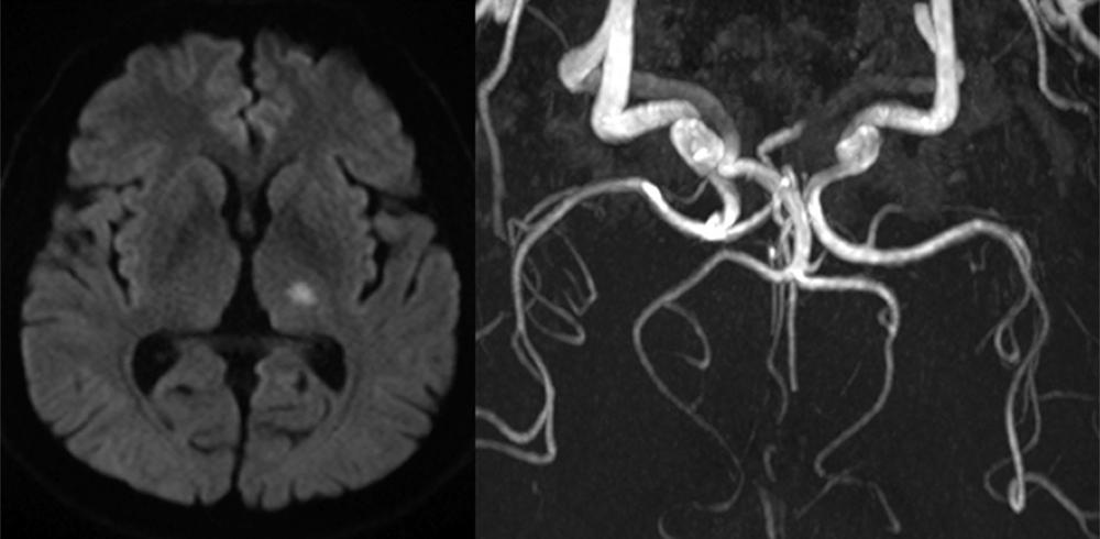 Fig. 25.10, A 55-year-old hypertensive man suddenly felt tingling sensation in the left face and distal limbs. Pinprick and touch sensation were mildly decreased in these areas. Diffusion-weighted MRI showed a small, left lateral thalamic infarction. MR angiogram findings were normal.