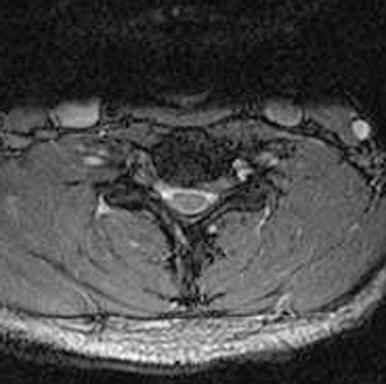 FIGURE 36-1, Axial magnetic resonance imaging demonstrating a left C6-C7 foraminal disk herniation.